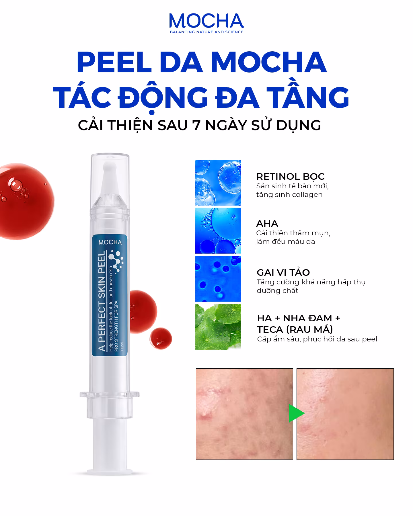 Peel Da Mocha – Bí Quyết Tái Tạo và Cải Thiện Nám