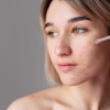 TOP 7 Serum mụn cho tuổi dậy thì được tin dùng nhất 2025