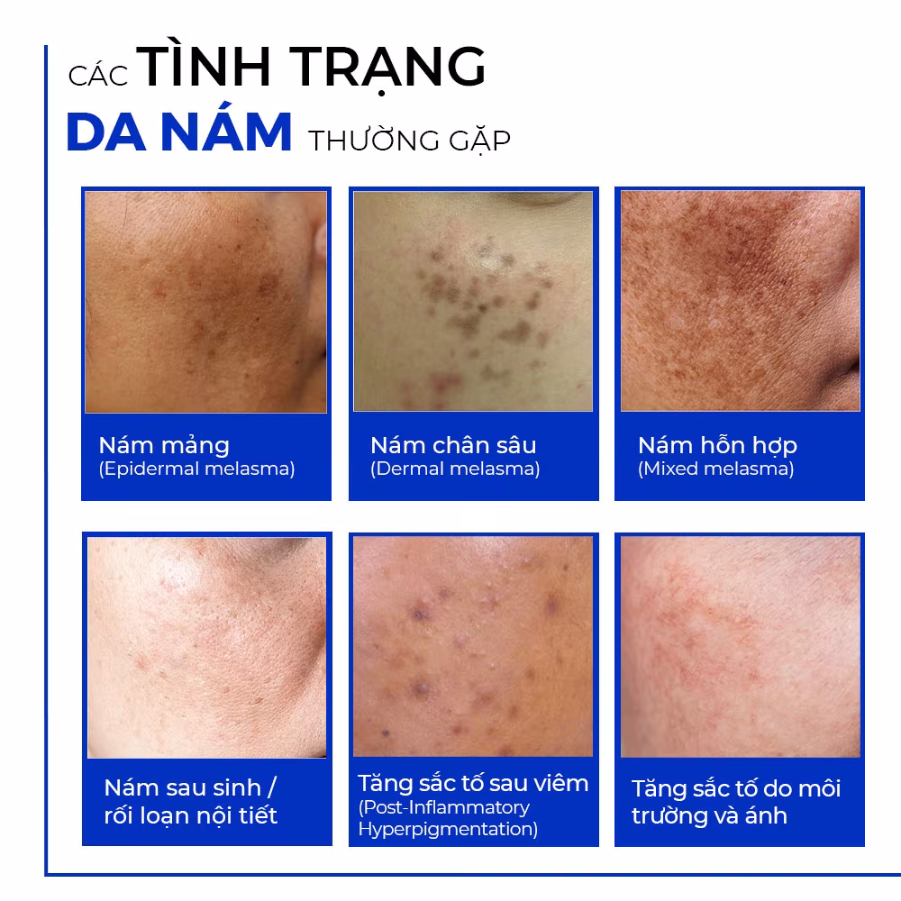 Top 5 sai lầm xử lý nám khiến da càng đậm màu mà chuyên gia MOCHA cảnh báo 1 Top 5 sai lầm xử lý nám khiến da càng đậm màu mà chuyên gia MOCHA cảnh báo