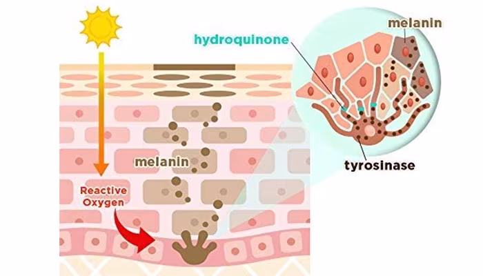 HẬU QUẢ VIỆC ĐIỀU TRỊ NÁM BẰNG HYDROQUINONE