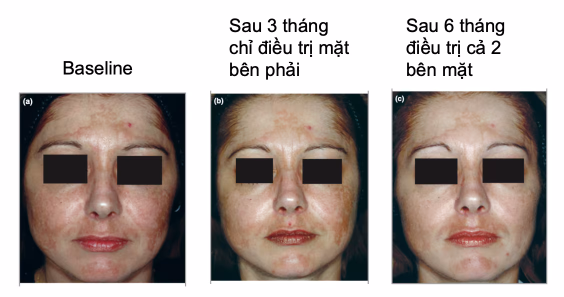 Actosome Whitenol - Hoạt chất làm sáng da thế hệ mới 5 Actosome Whitenol – Hoạt chất làm sáng da thế hệ mới