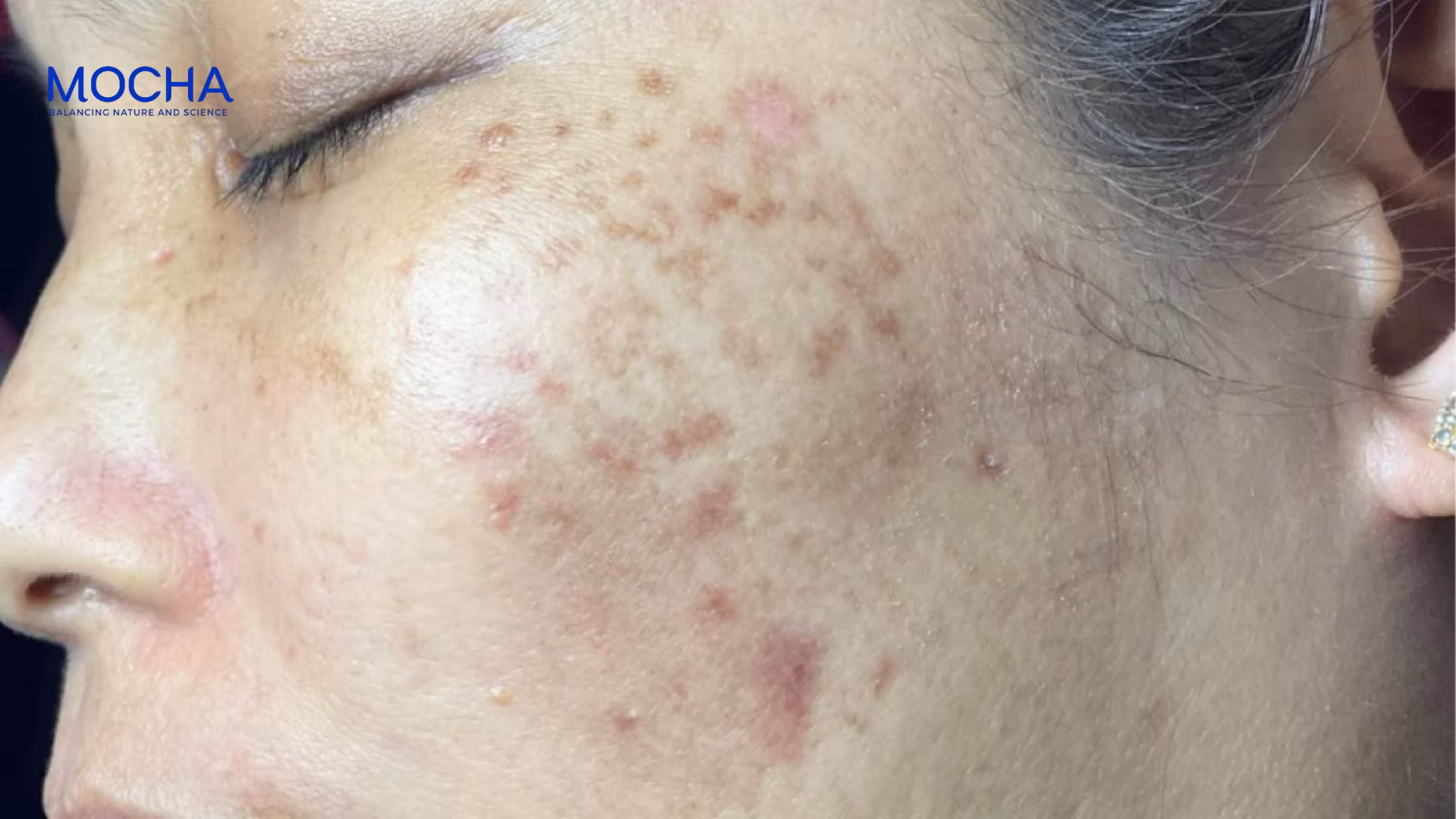 Đặc điểm của nám chân đinh và hoạt chất điều trị hiệu quả