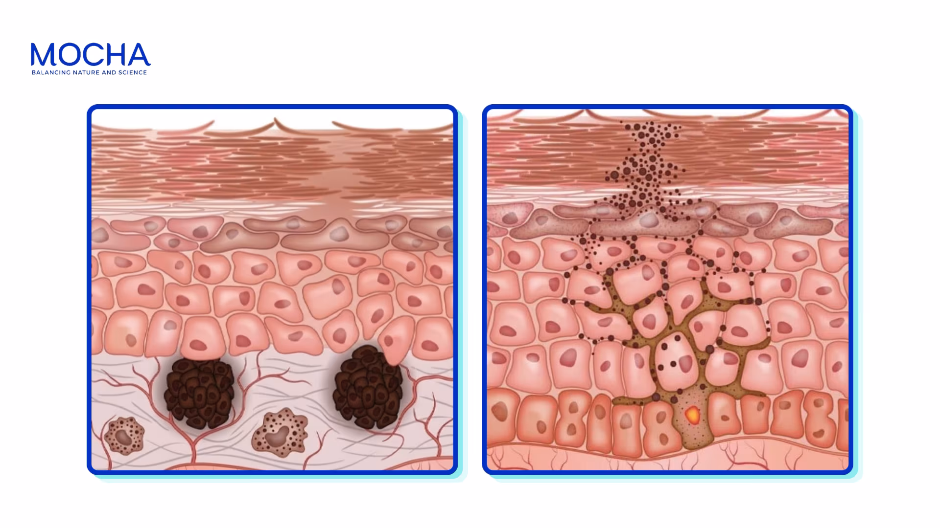 Đặc điểm của nám chân đinh và hoạt chất điều trị hiệu quả