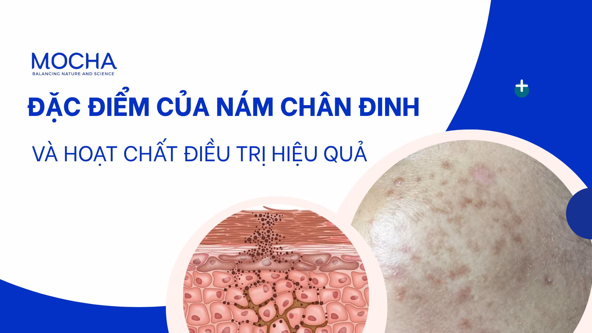 Đặc điểm của nám chân đinh và hoạt chất điều trị hiệu quả
