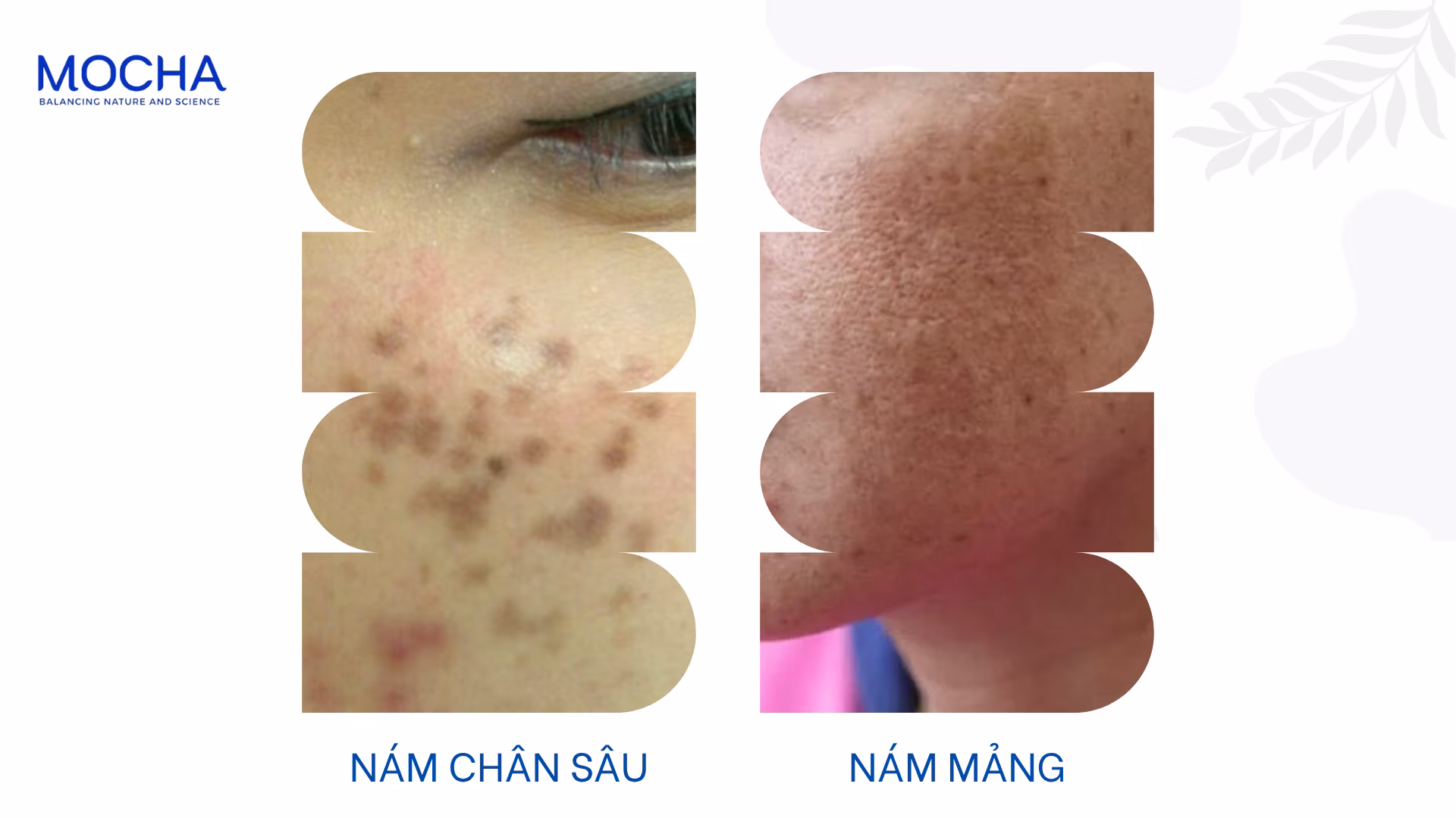 Phân biệt nám chân sâu và nám mảng: Bí quyết chọn đúng phương pháp điều trị