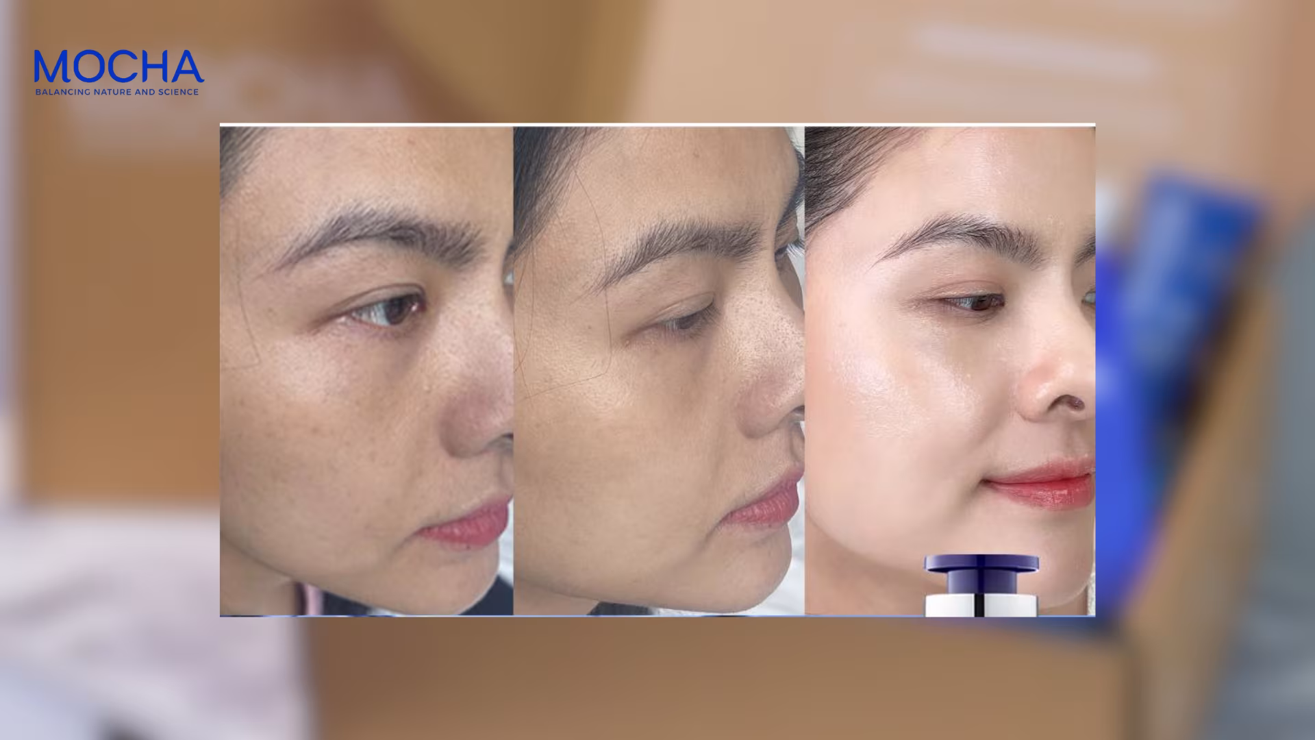 Phân biệt nám chân sâu và nám mảng: Bí quyết chọn đúng phương pháp điều trị