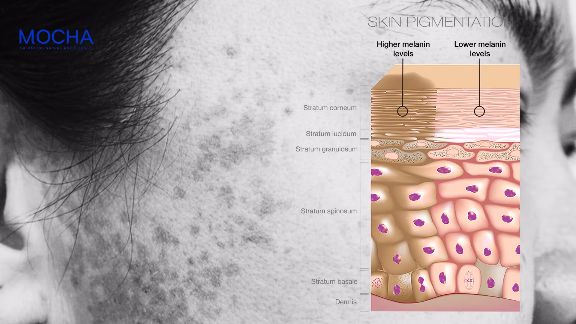 Điều trị nám hỗn hợp: Sự kết hợp giữa tấn công gốc nám và phục hồi nền da