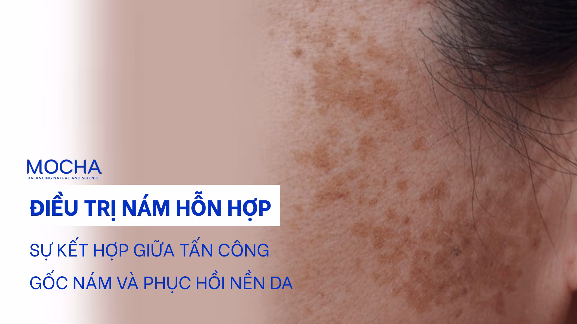 Điều trị nám hỗn hợp: Sự kết hợp giữa tấn công gốc nám và phục hồi nền da