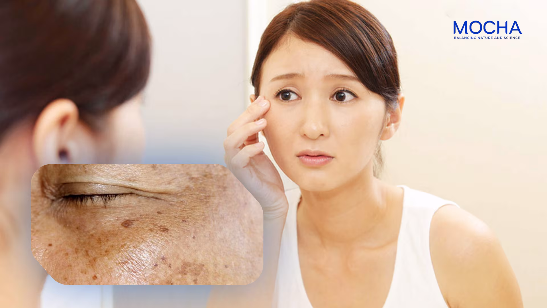 Nám lâu năm không khỏi dù dùng nhiều loại – Giải pháp hiệu quả từ chuyên gia của Mocha