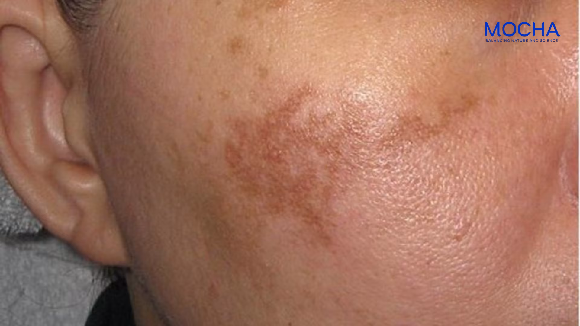 Cách nhận biết và điều trị nám mảng hiệu quả stại nhà