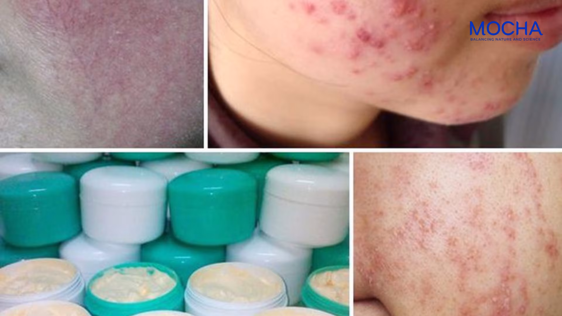 Cách nhận biết và điều trị nám mảng hiệu quả stại nhà