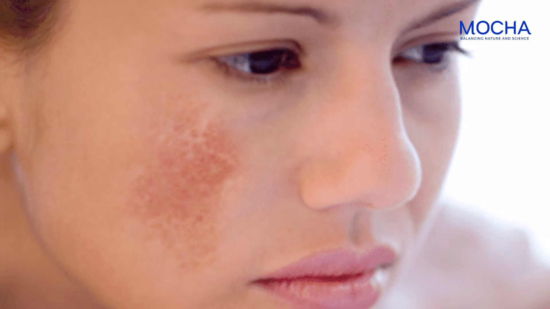 Cách nhận biết và điều trị nám mảng hiệu quả stại nhà