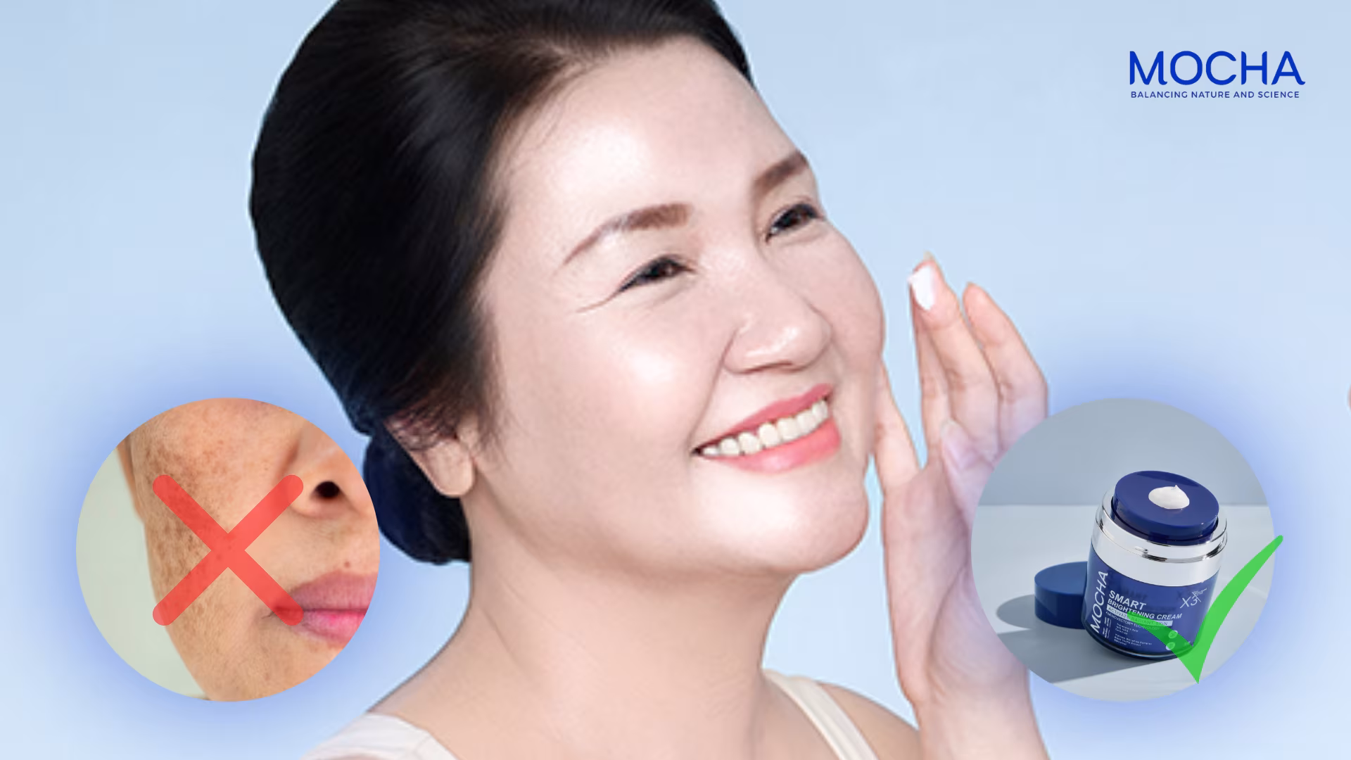 Cách nhận biết và điều trị nám mảng hiệu quả stại nhà