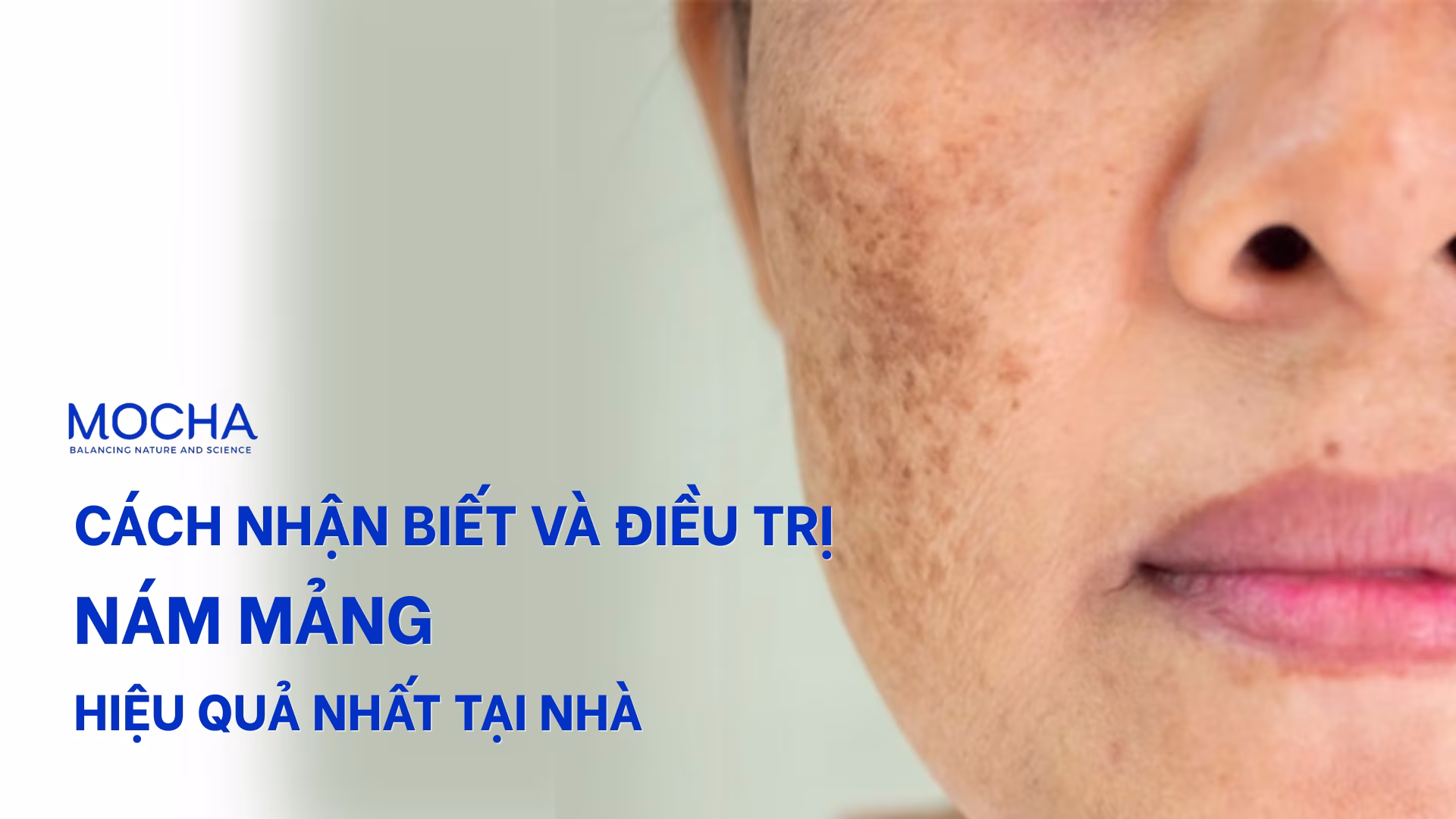 Cách nhận biết và điều trị nám mảng hiệu quả sau 4 tuần tại nhà
