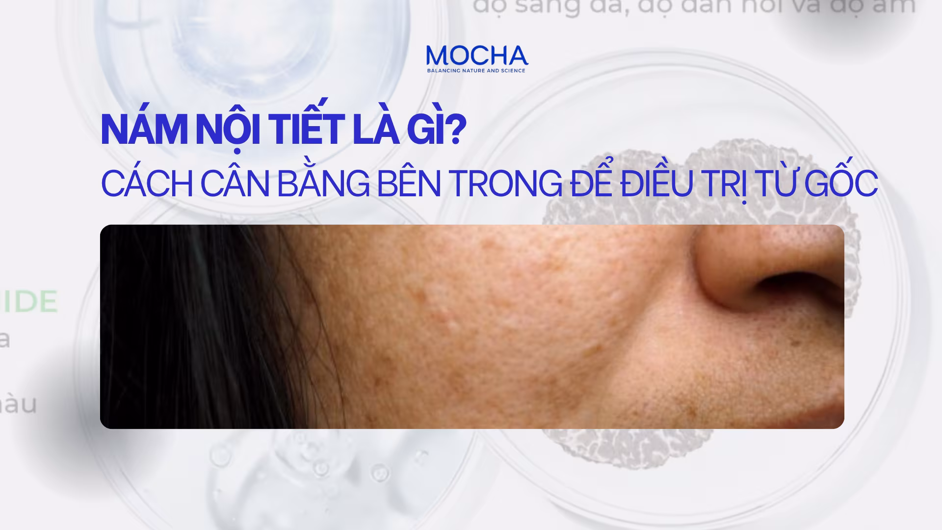 Nám nội tiết là gì? 3 bước điều trị nám từ gốc