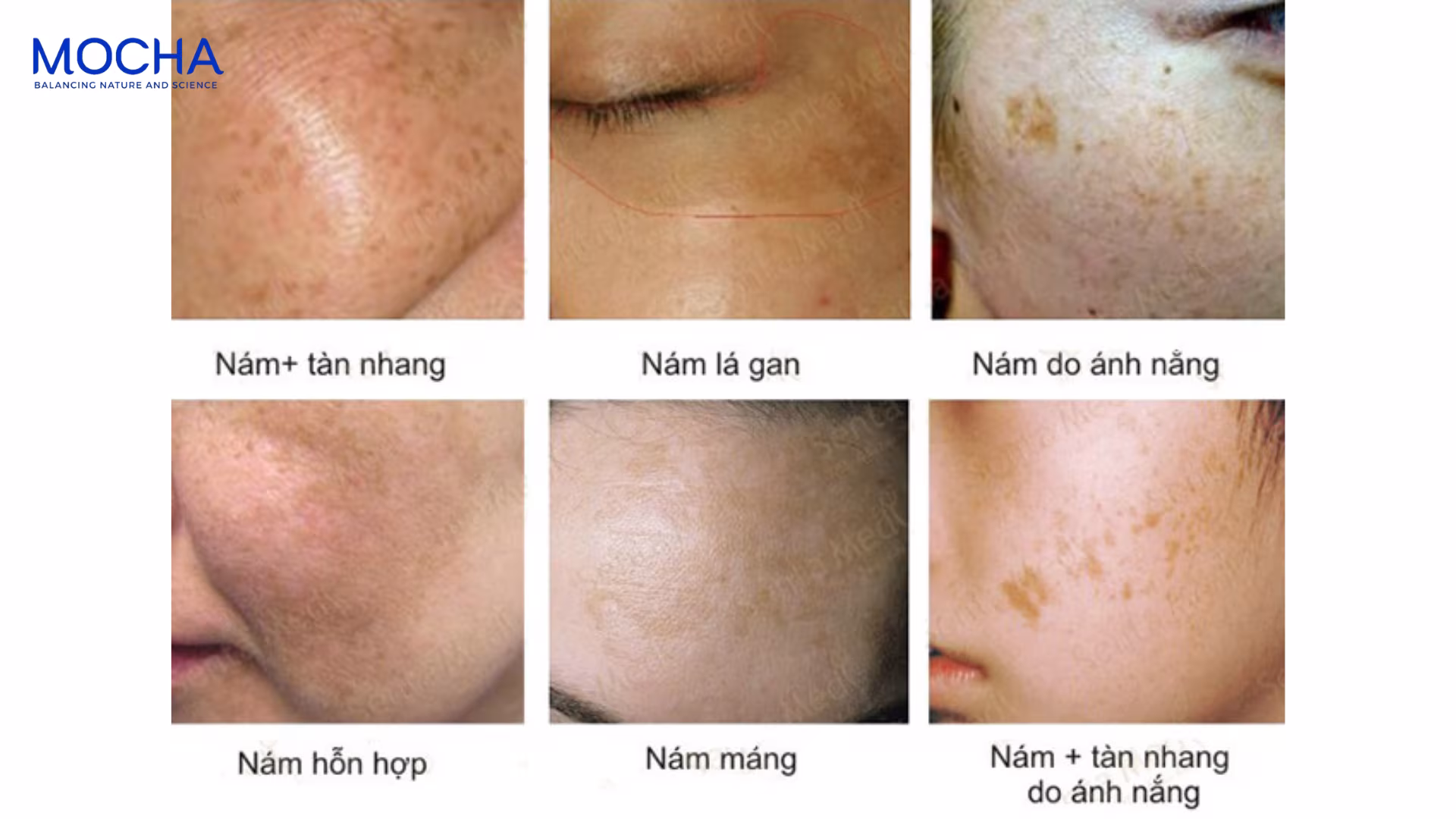 5 nguyên nhân gây nám da hàng đầu mà phụ nữ Việt thường bỏ qua