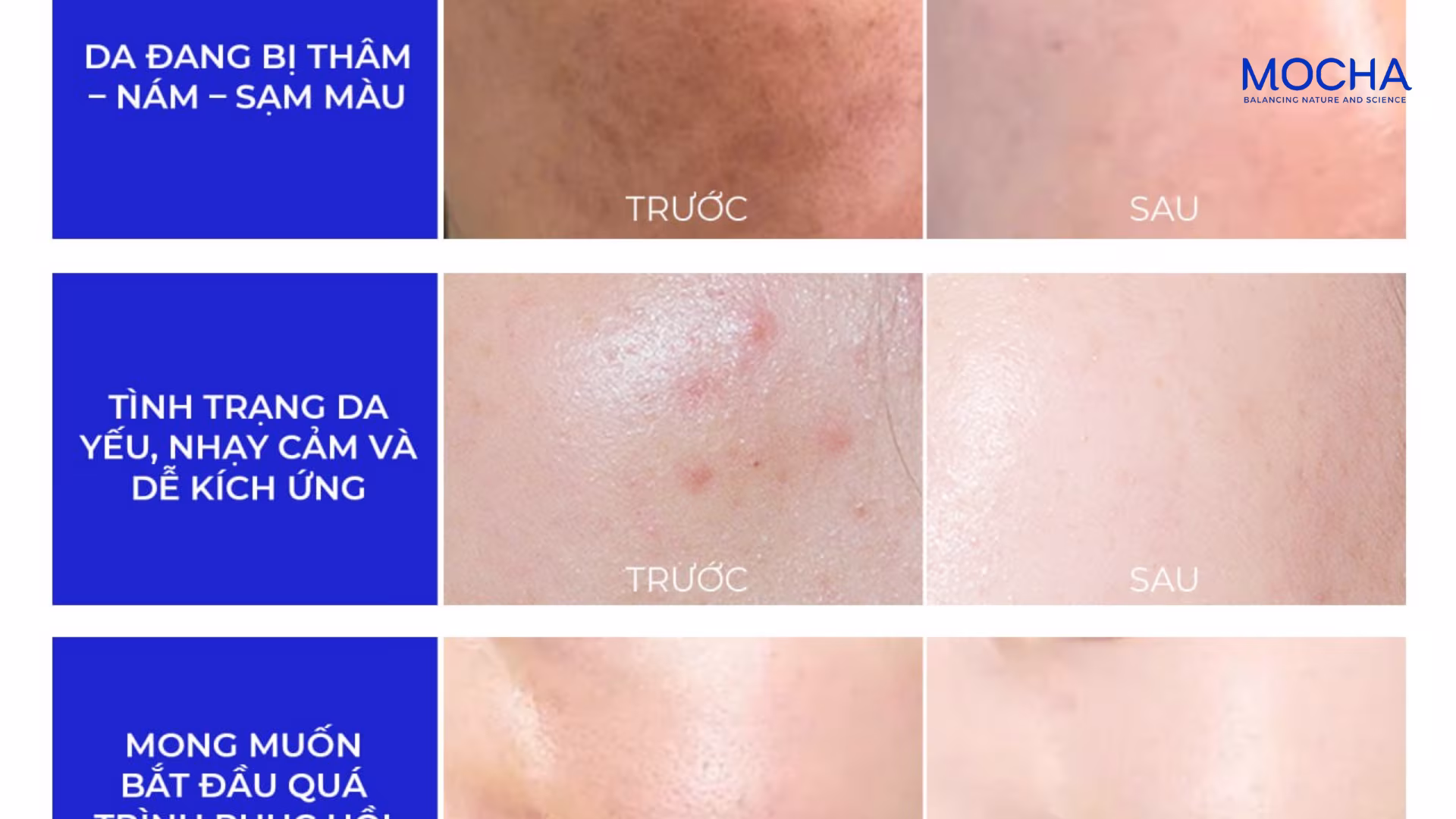 Phác đồ nám Mocha: Cơ chế 3 tầng giúp ngăn ngừa nám tái phát