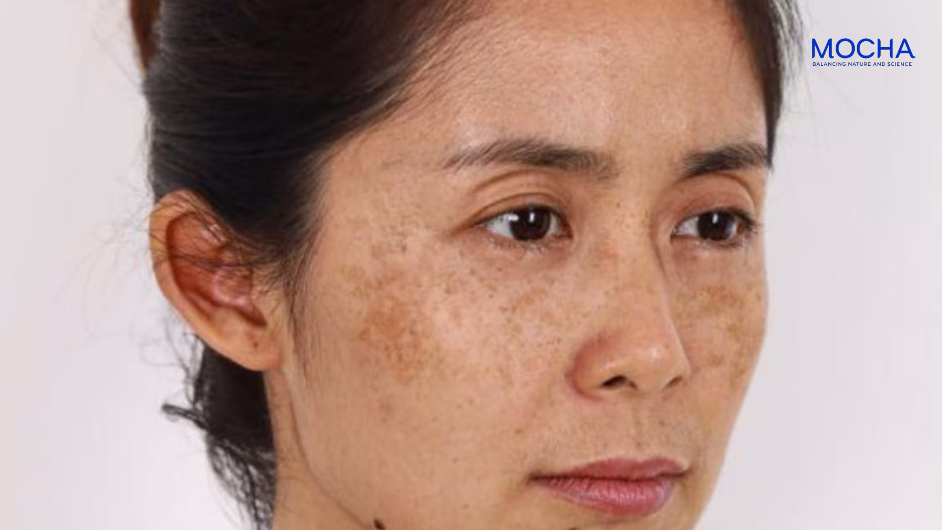 8 cách phân biệt nám tàn nhang và đồi mồi chính xác nhất