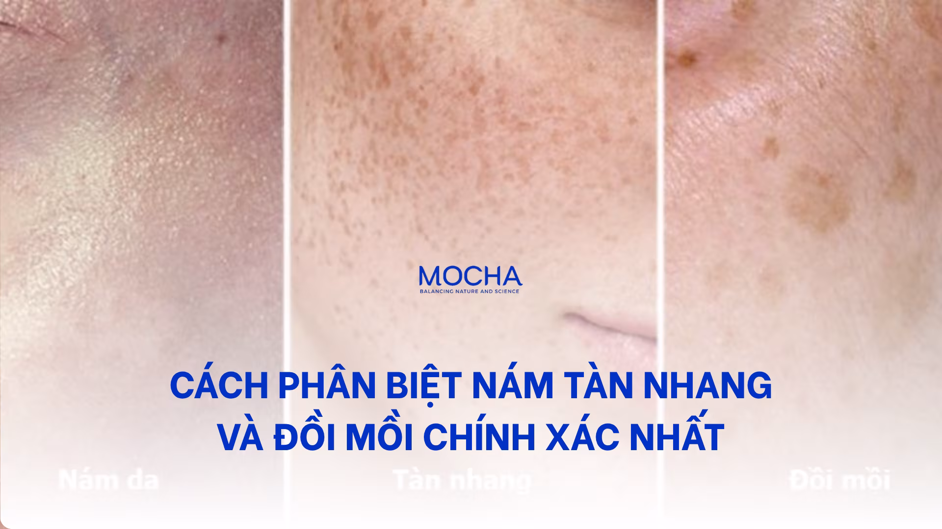 8 cách phân biệt nám tàn nhang và đồi mồi chính xác nhất
