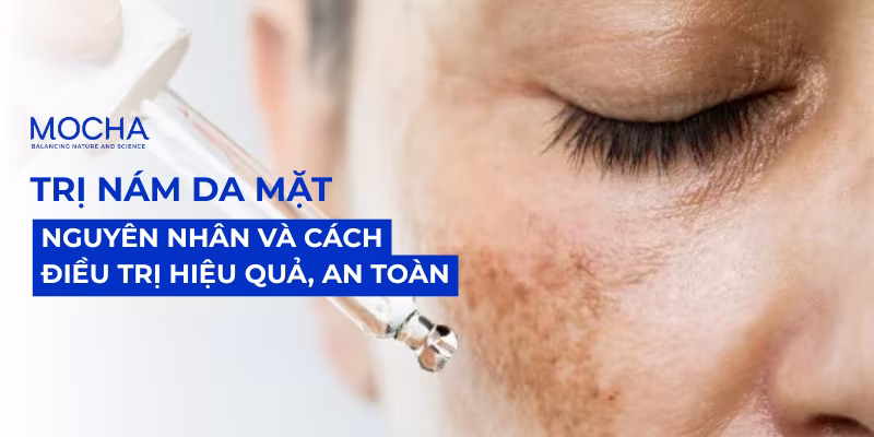 Trị nám da mặt: Nguyên nhân và cách điều trị hiệu quả, an toàn