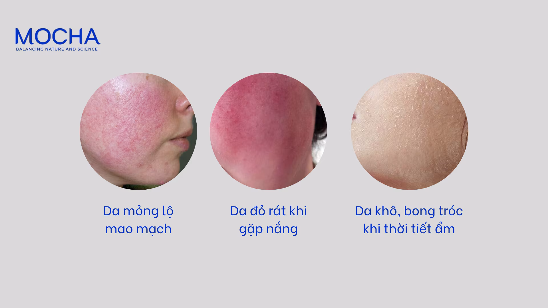 Da mỏng yếu có nên peel da không và 4 bí quyết an toàn khi peel