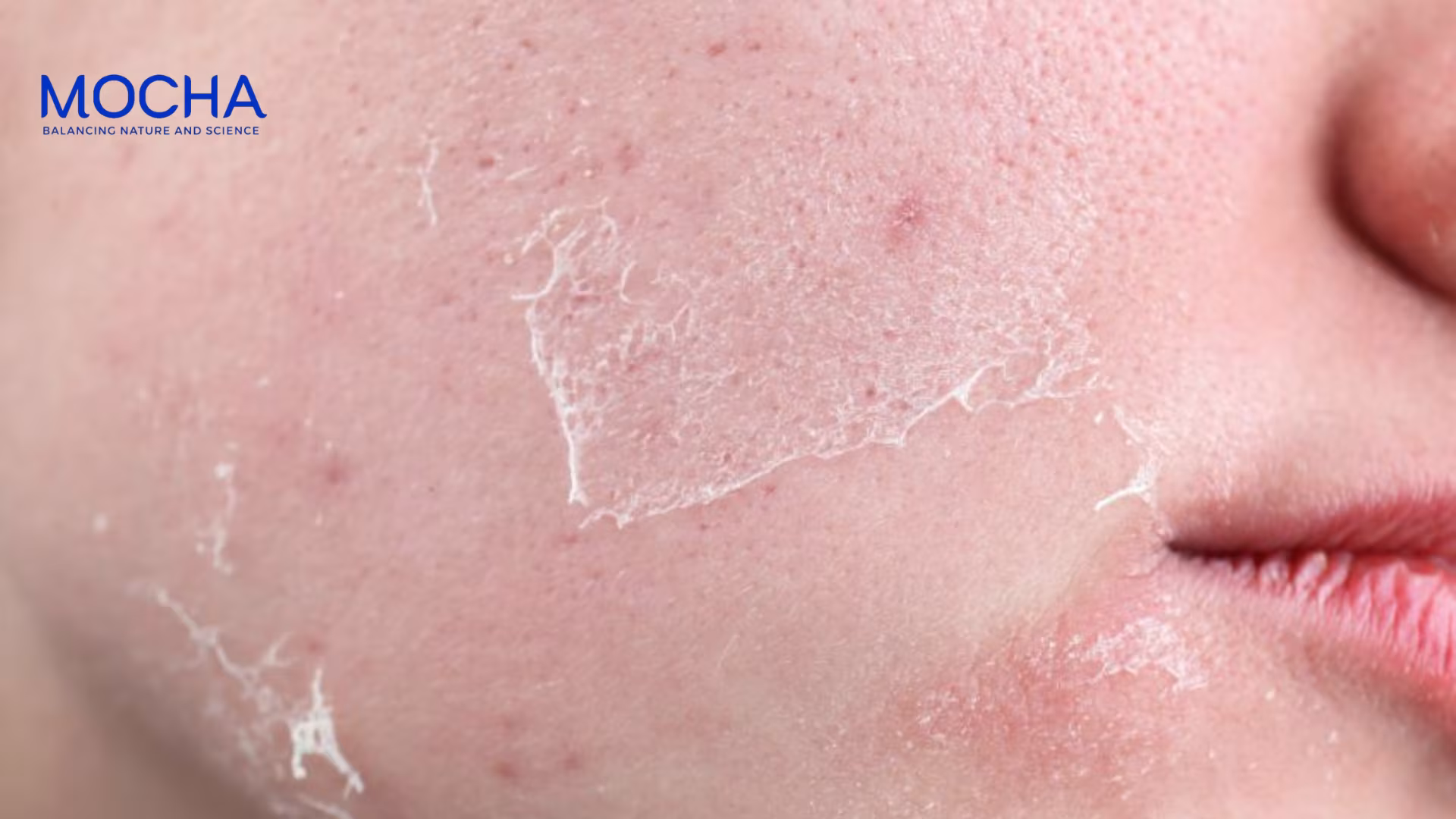 Da mỏng yếu có nên peel da không và 4 bí quyết an toàn khi peel