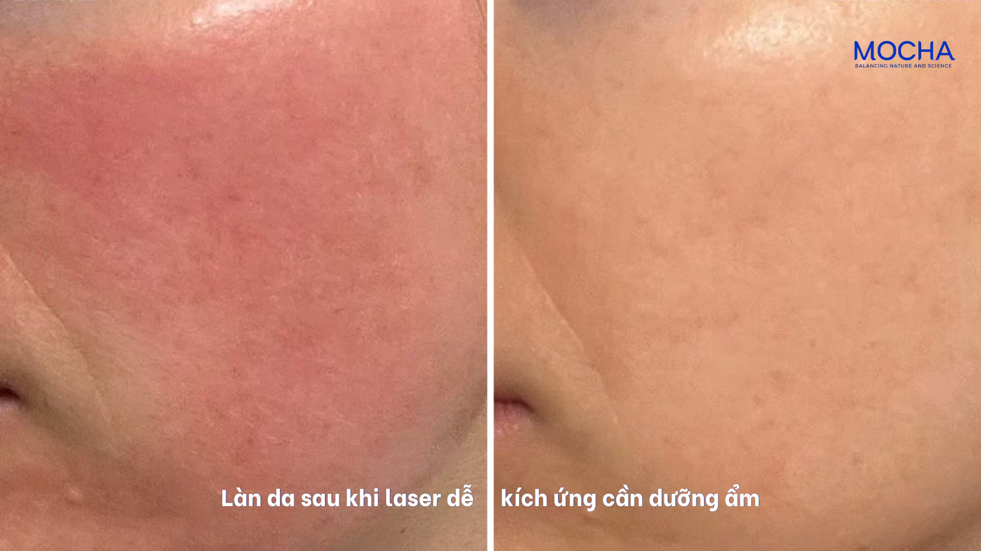 4 lý do da nám cần được dưỡng ẩm chuyên sâu để tăng hiệu quả điều trị