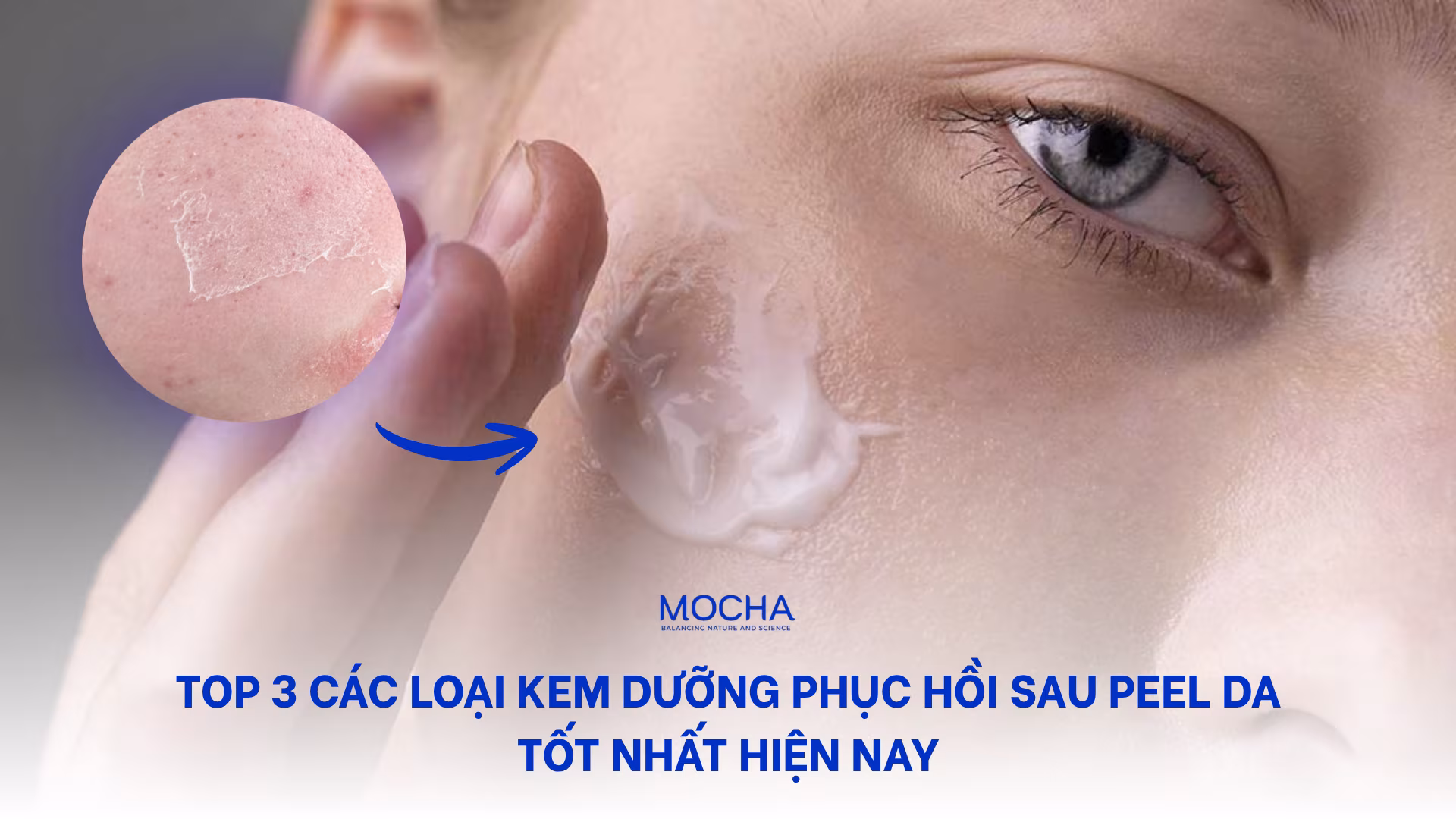 Top 3 các loại kem dưỡng phục hồi sau peel da tốt nhất hiện nay