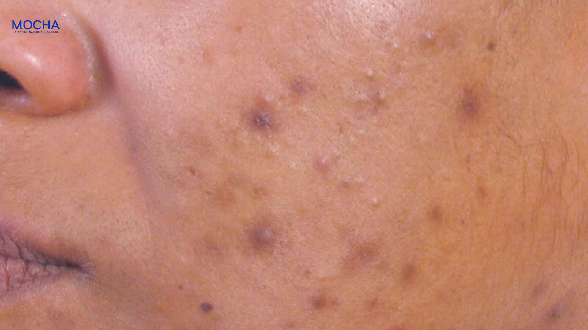 Kem trị thâm Mocha: 7 công dụng mờ thâm mụn, làm sáng và đều màu da hiệu quả