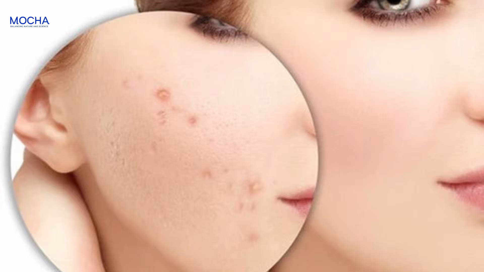 Kem trị thâm Mocha: 7 công dụng mờ thâm mụn, làm sáng và đều màu da hiệu quả