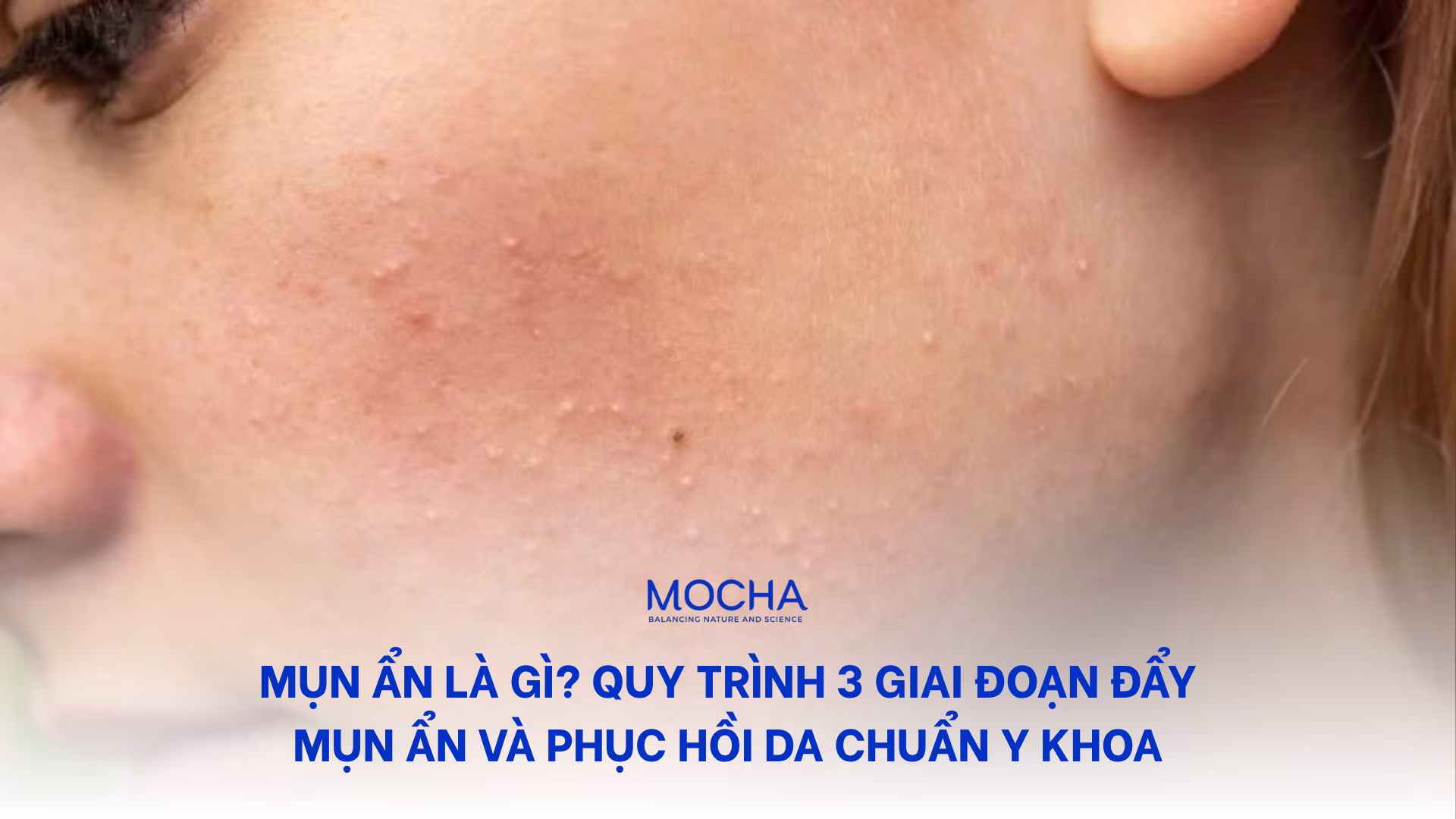 Mụn ẩn là gì? Quy trình 3 giai đoạn đẩy mụn ẩn và phục hồi da chuẩn y khoa