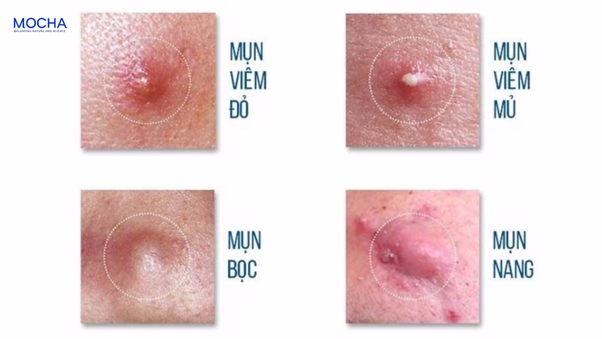 3 bước xử lý mụn viêm an toàn để tránh để lại sẹo lõm và thâm lâu ngày