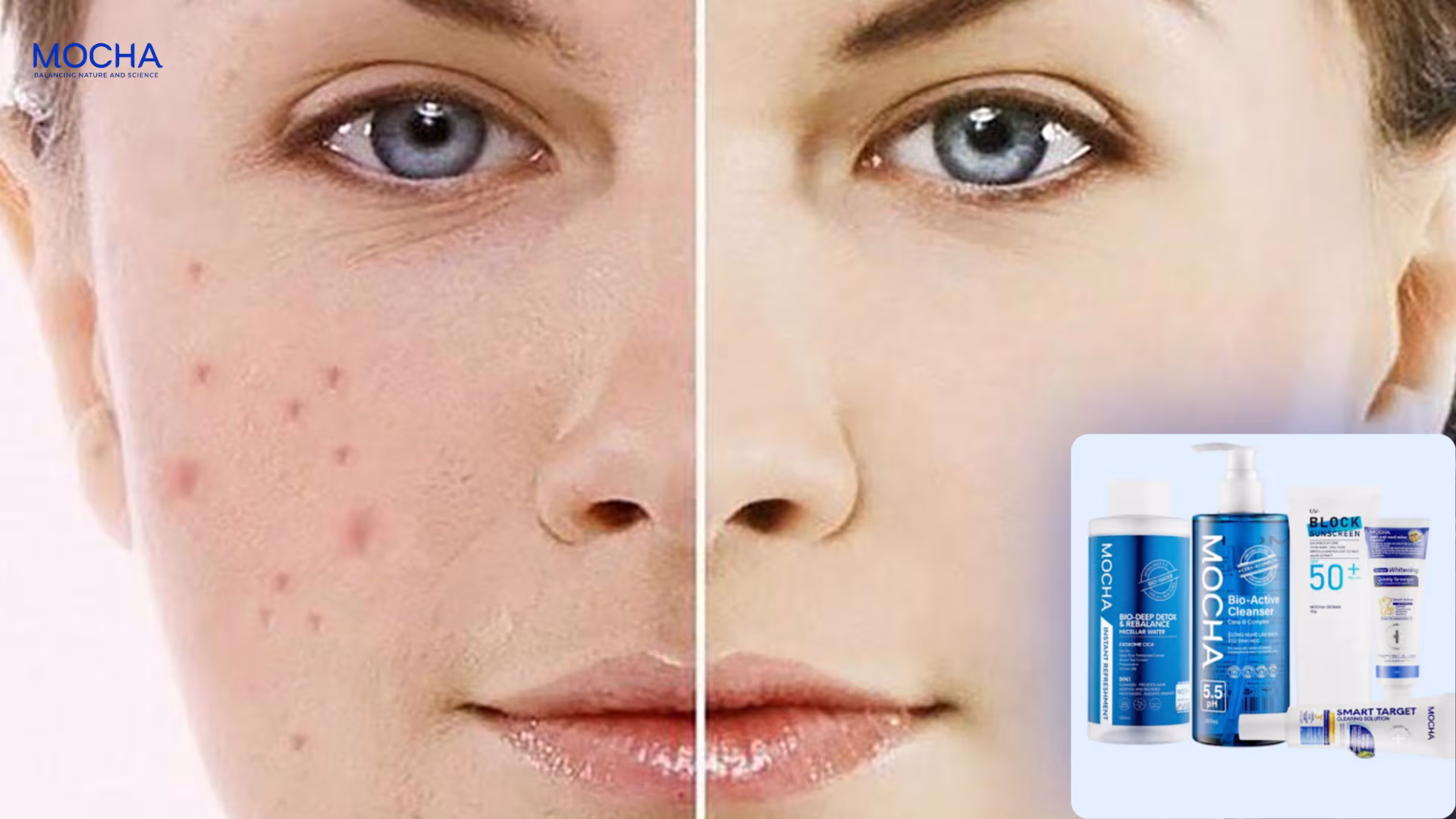 3 bước xử lý mụn viêm an toàn để tránh để lại sẹo lõm và thâm lâu ngày