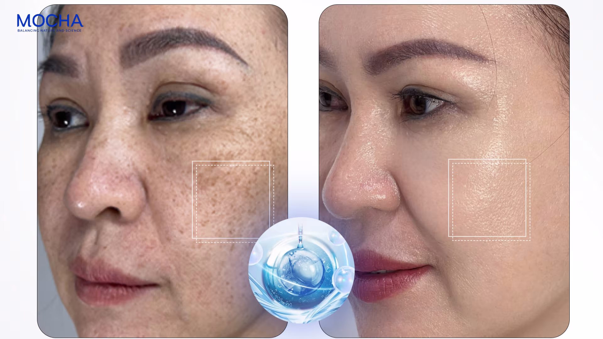 Bí quyết giúp nám mờ sau 4 tuần cùng Combo nám Mocha Smart 6in1