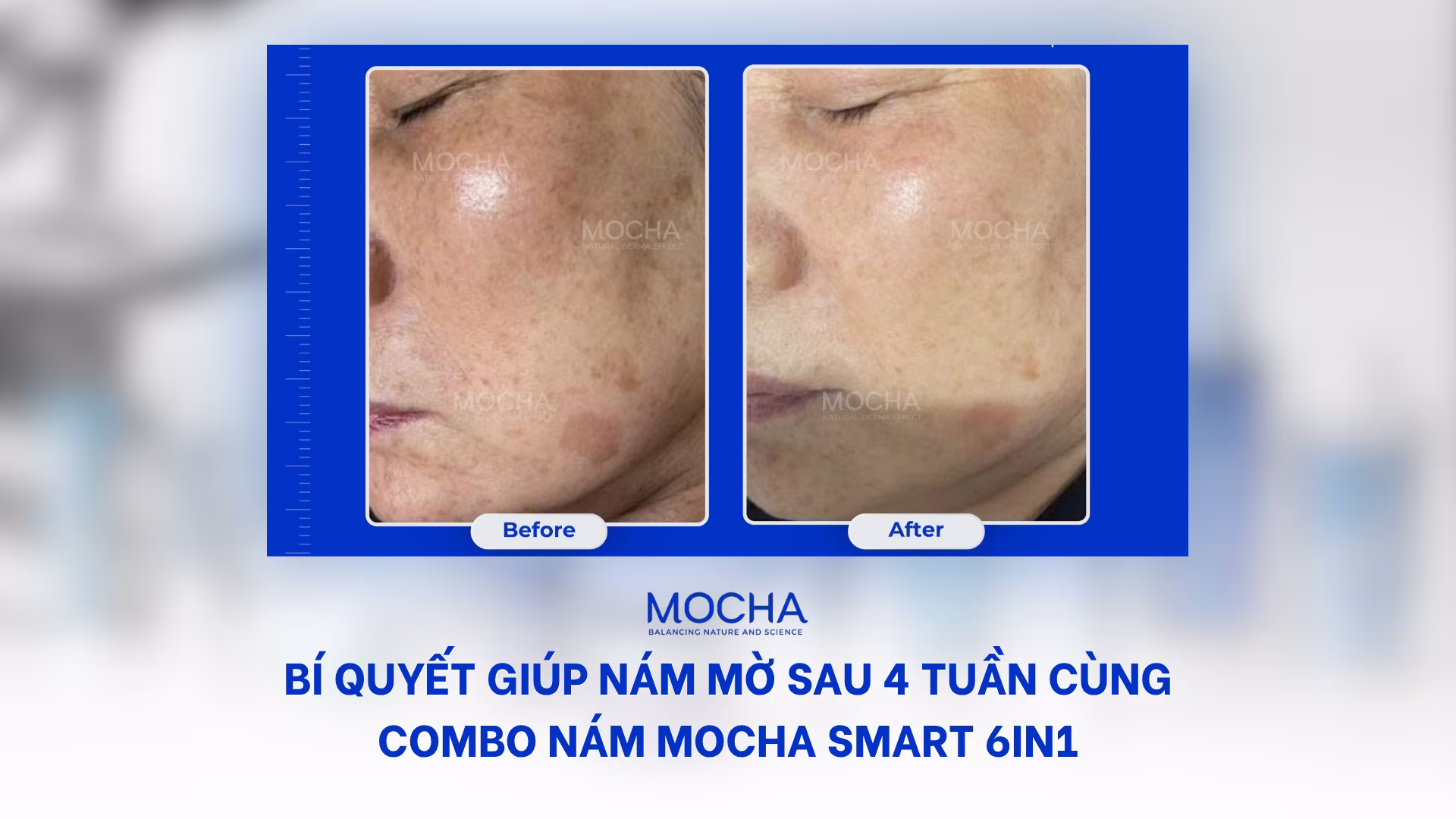 Bí quyết giúp nám mờ sau 4 tuần cùng Combo nám Mocha Smart 6in1