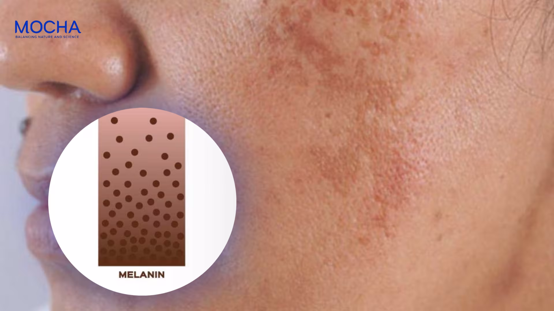 5 nguyên nhân khiến da mãi nám sạm – Giải pháp từ chuyên gia