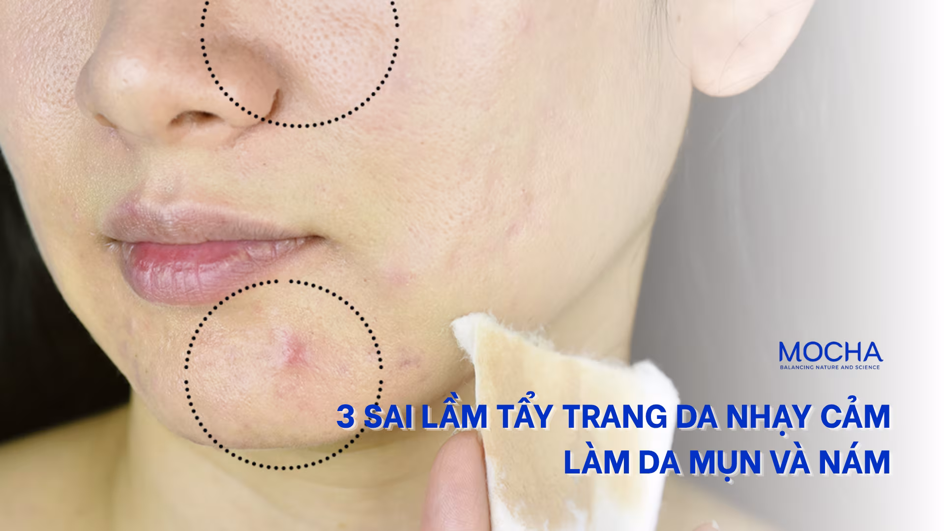 3 sai lầm tẩy trang da nhạy cảm làm da mụn và nám