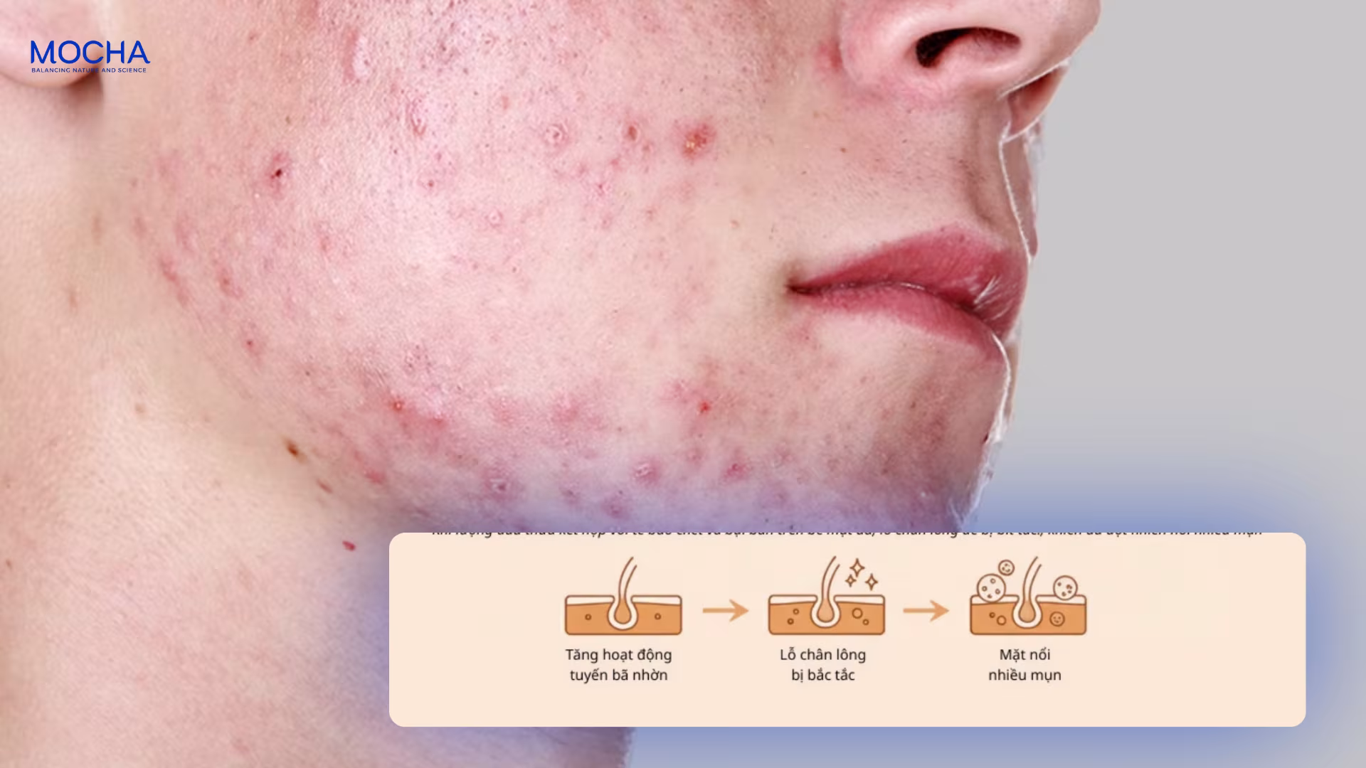 5 tiêu chí lựa chọn sản phẩm trị mụn an toàn cho làn da tuổi dậy thì