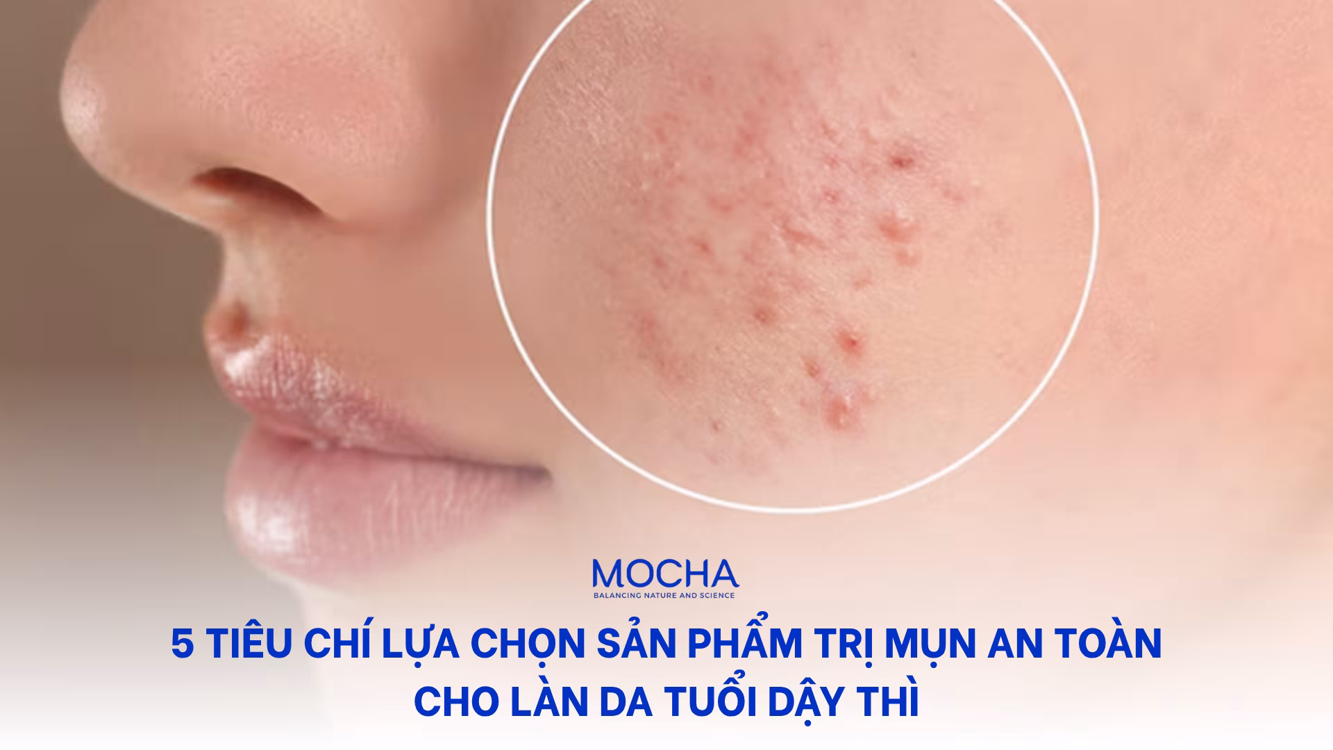 5 tiêu chí lựa chọn sản phẩm trị mụn an toàn cho làn da tuổi dậy thì