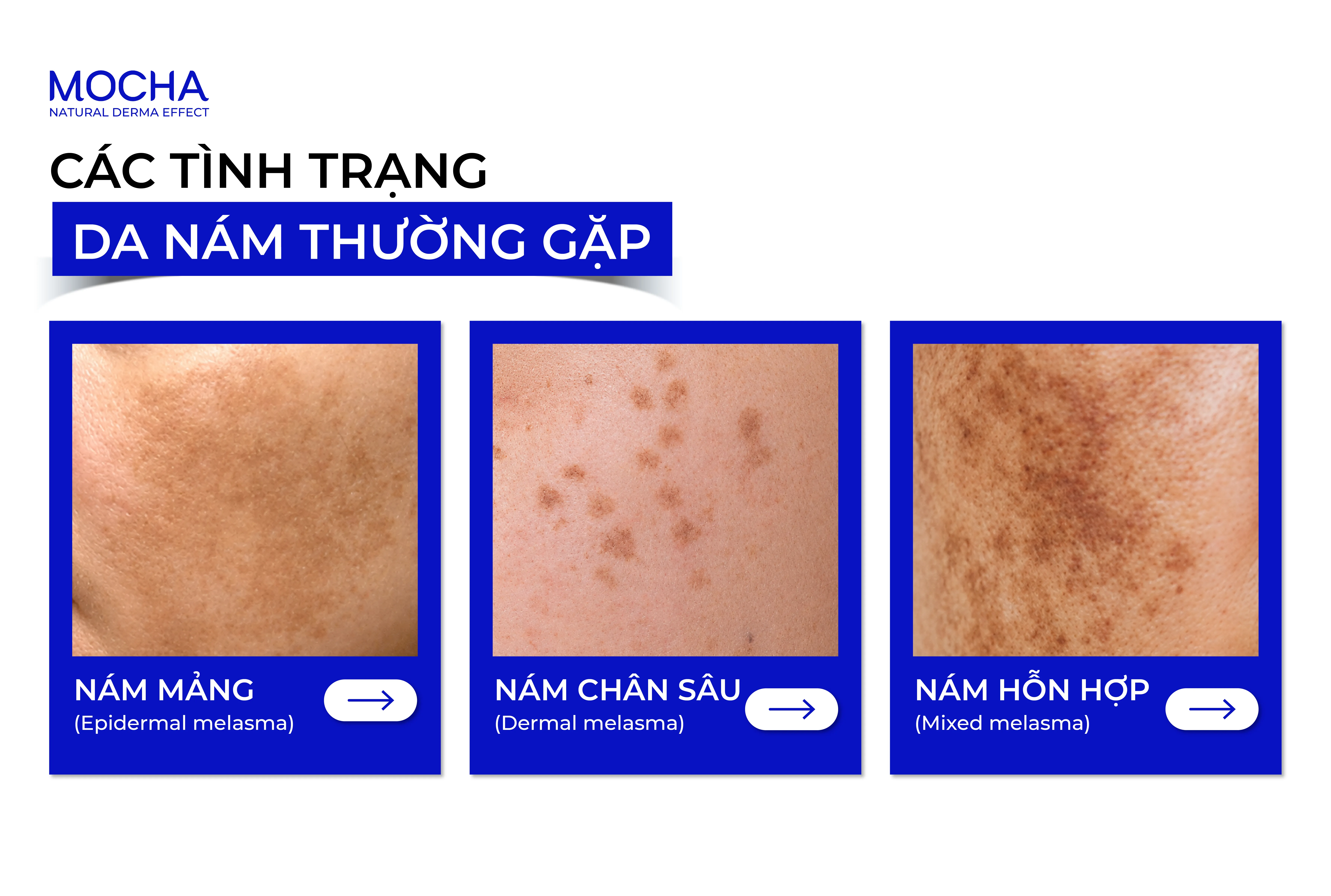 VÌ SAO NÁM KHÓ CẢI THIỆN VÀ CÁCH CẢI THIỆN NÁM AN TOÀN HIỆU QUẢ HIỆN NAY