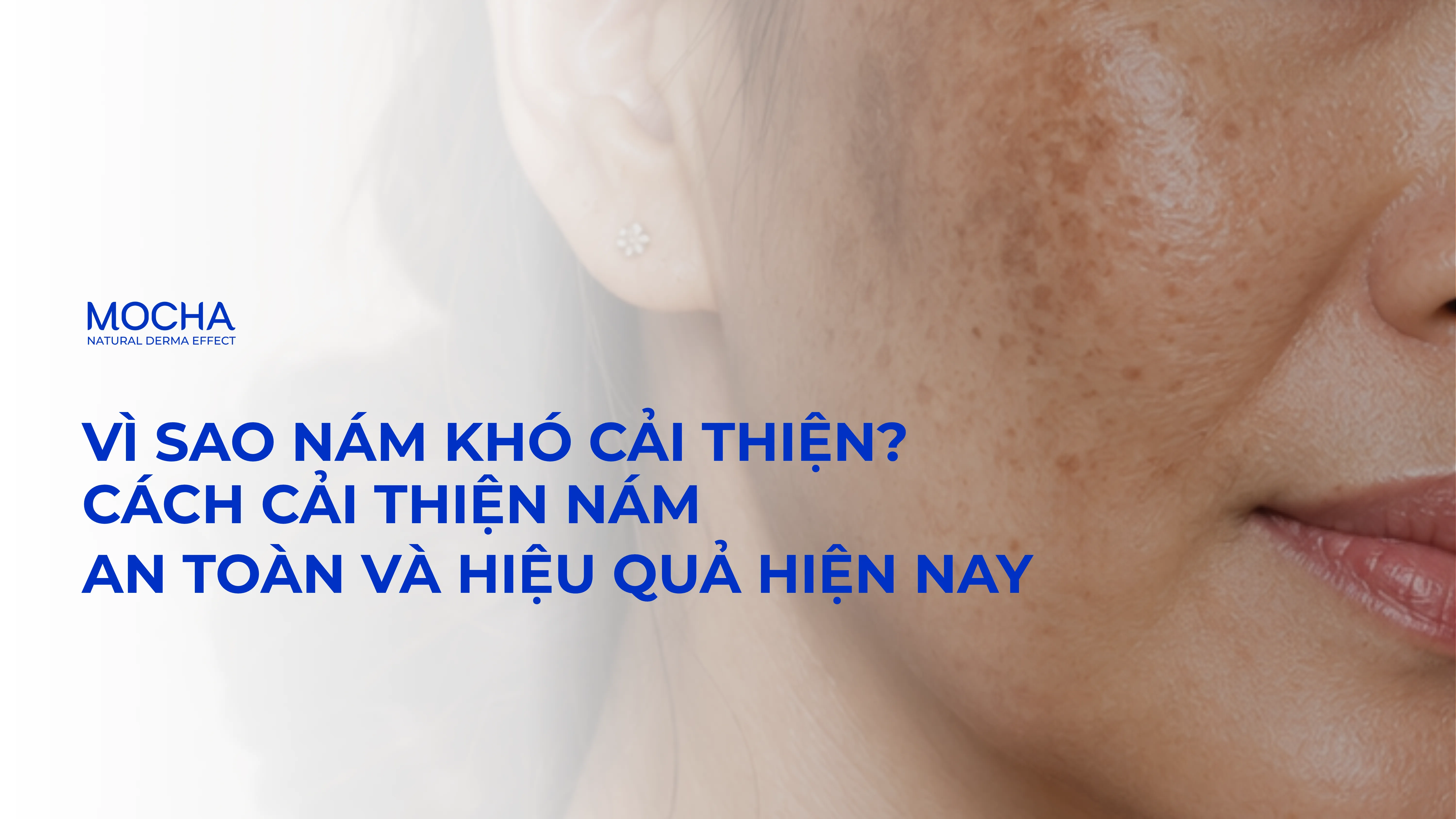 Vì sao nám khó cải thiện và cách cải thiện nám an toàn, hiệu quả hiện nay