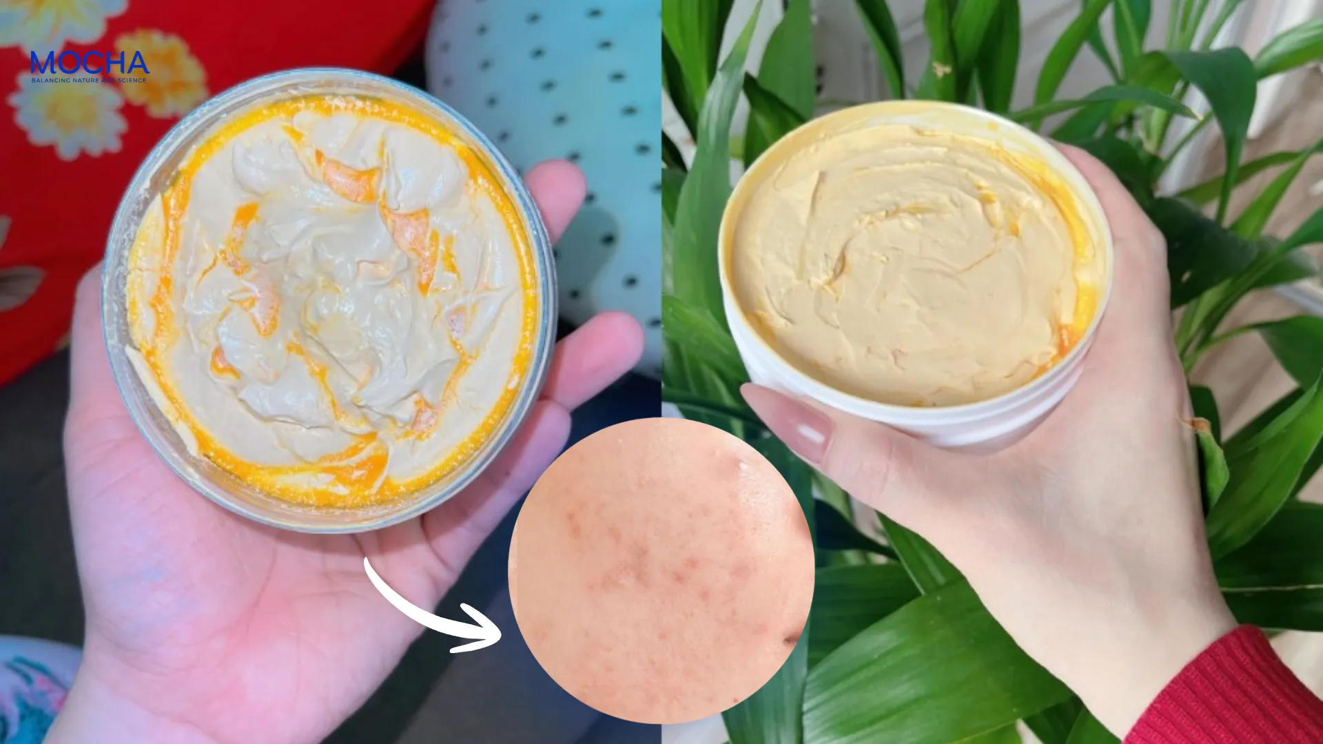 [TIÊU ĐIỂM] Combo trị mụn thâm toàn diện cho làn da chỉ trong 3 bước!