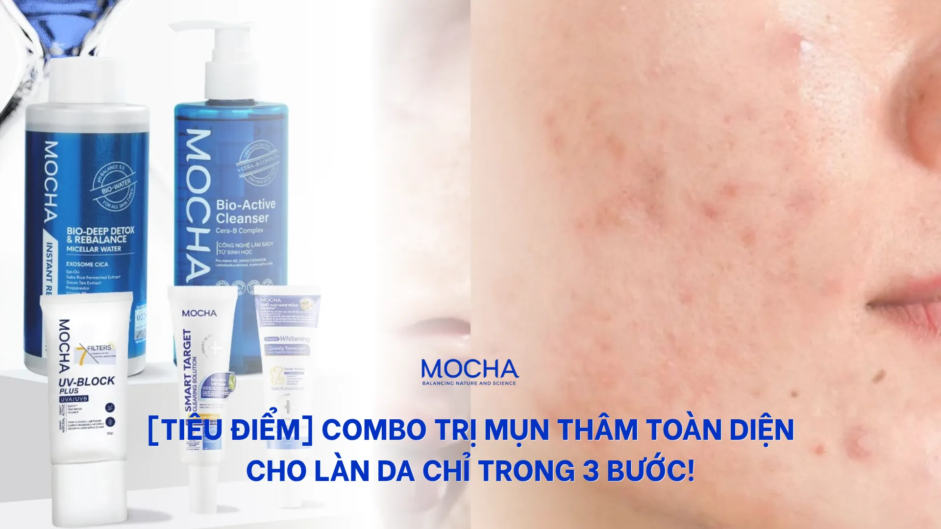 [TIÊU ĐIỂM] Combo trị mụn thâm toàn diện cho làn da chỉ trong 3 bước!