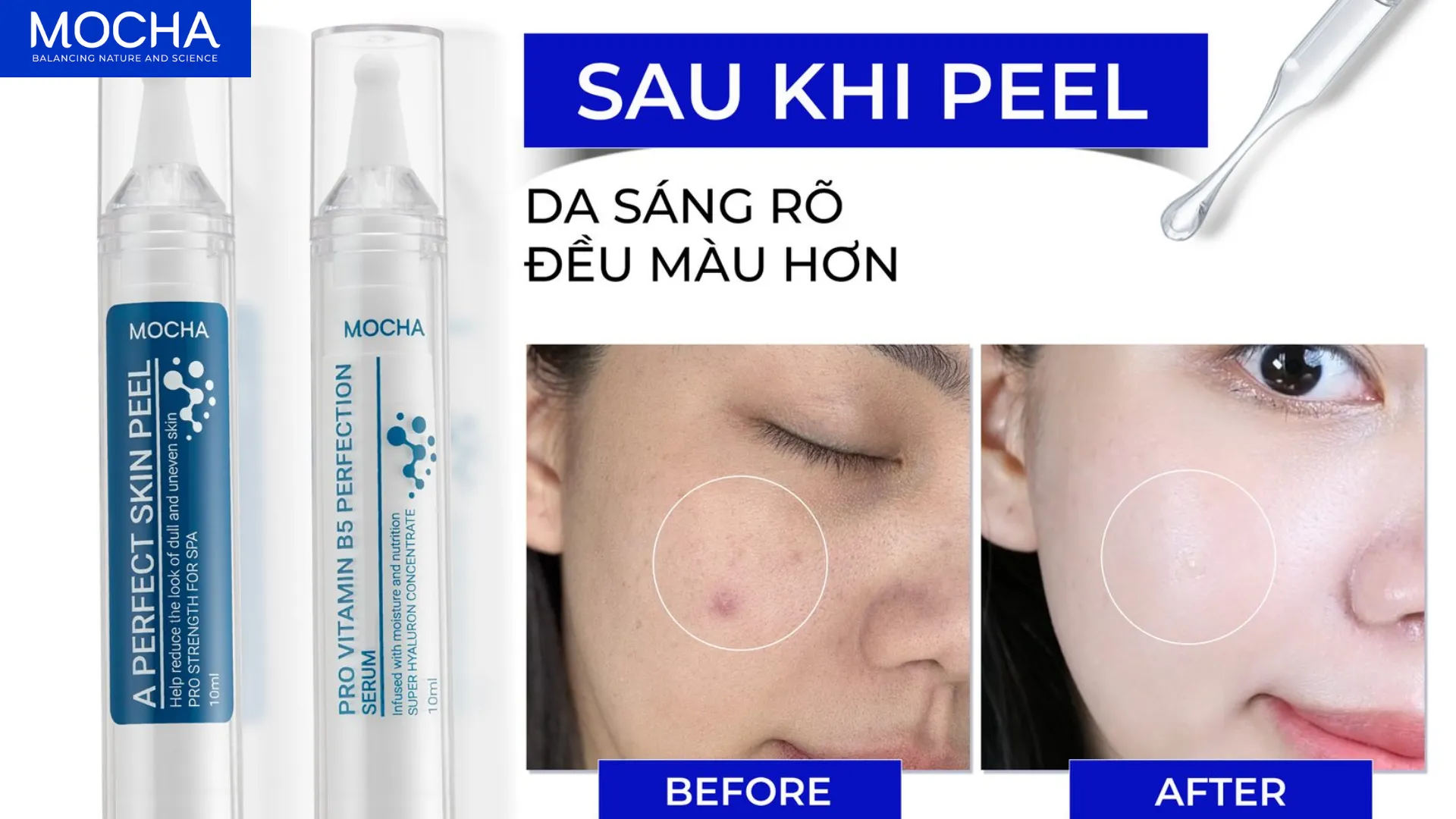 Da không đều màu là gì và 2 loại phổ biến nhất