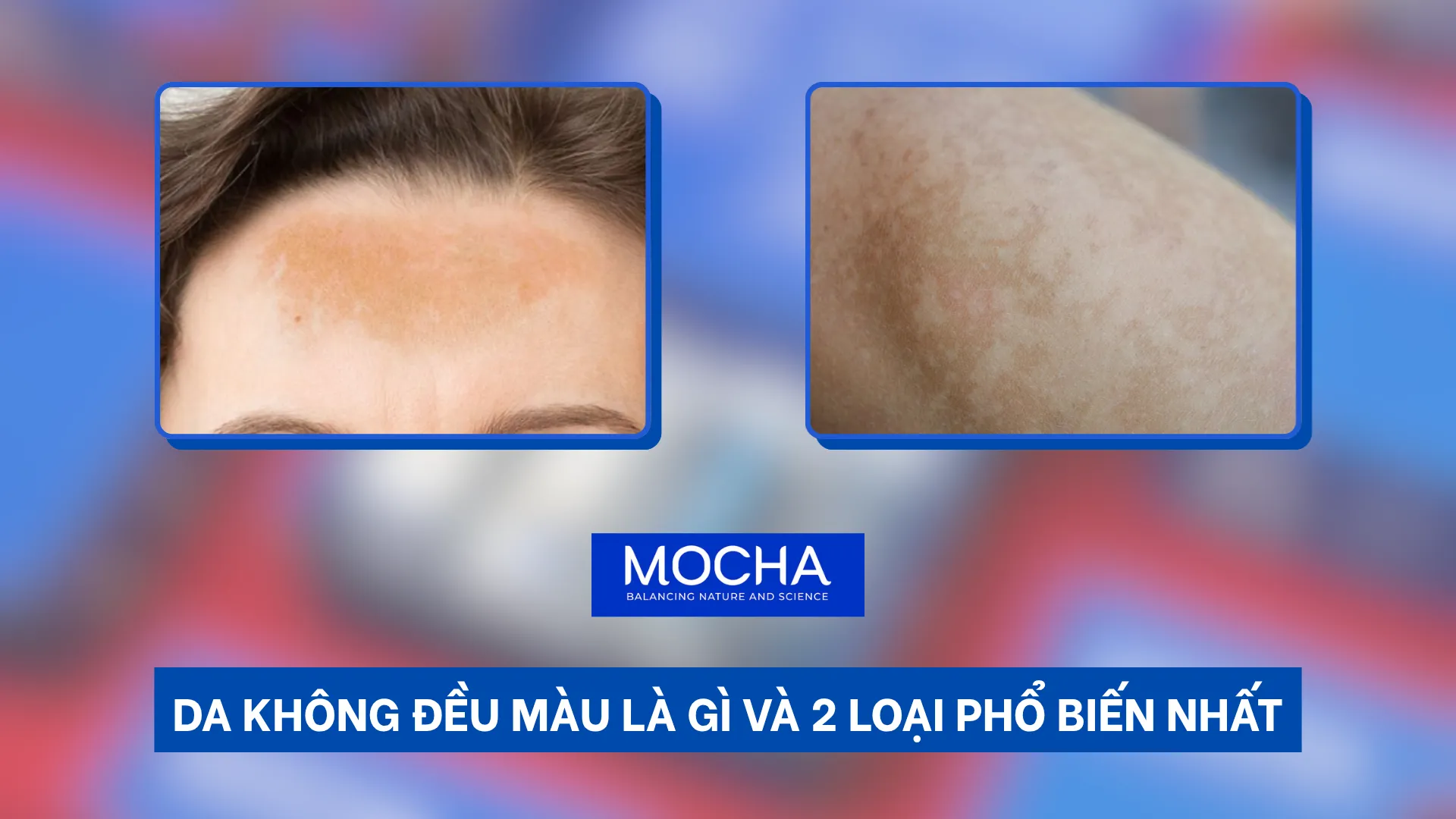 Da không đều màu là gì và 2 loại phổ biến nhất