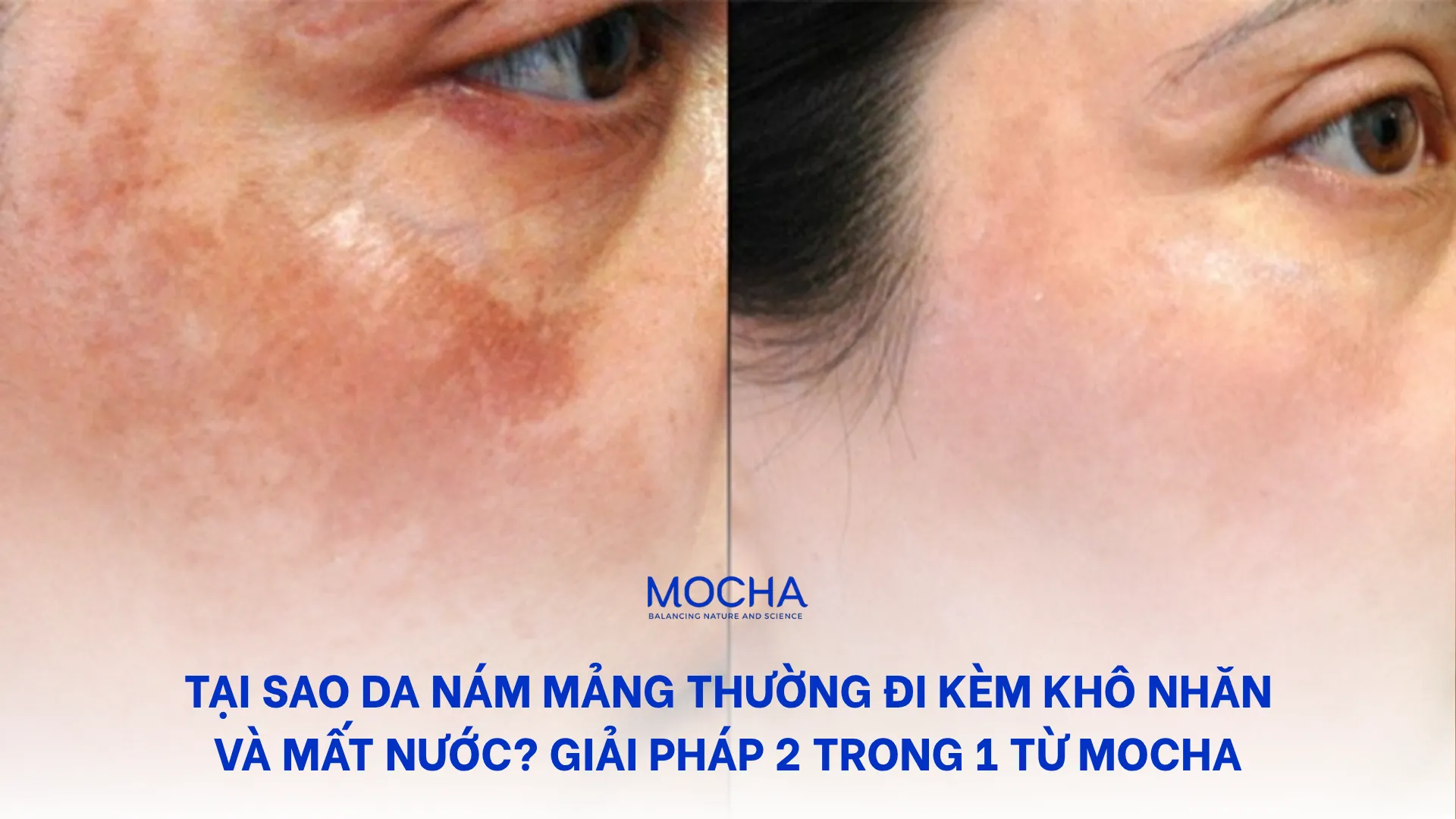 Tại sao da nám mảng thường đi kèm khô nhăn và mất nước? Giải pháp 2 trong 1 từ Mocha