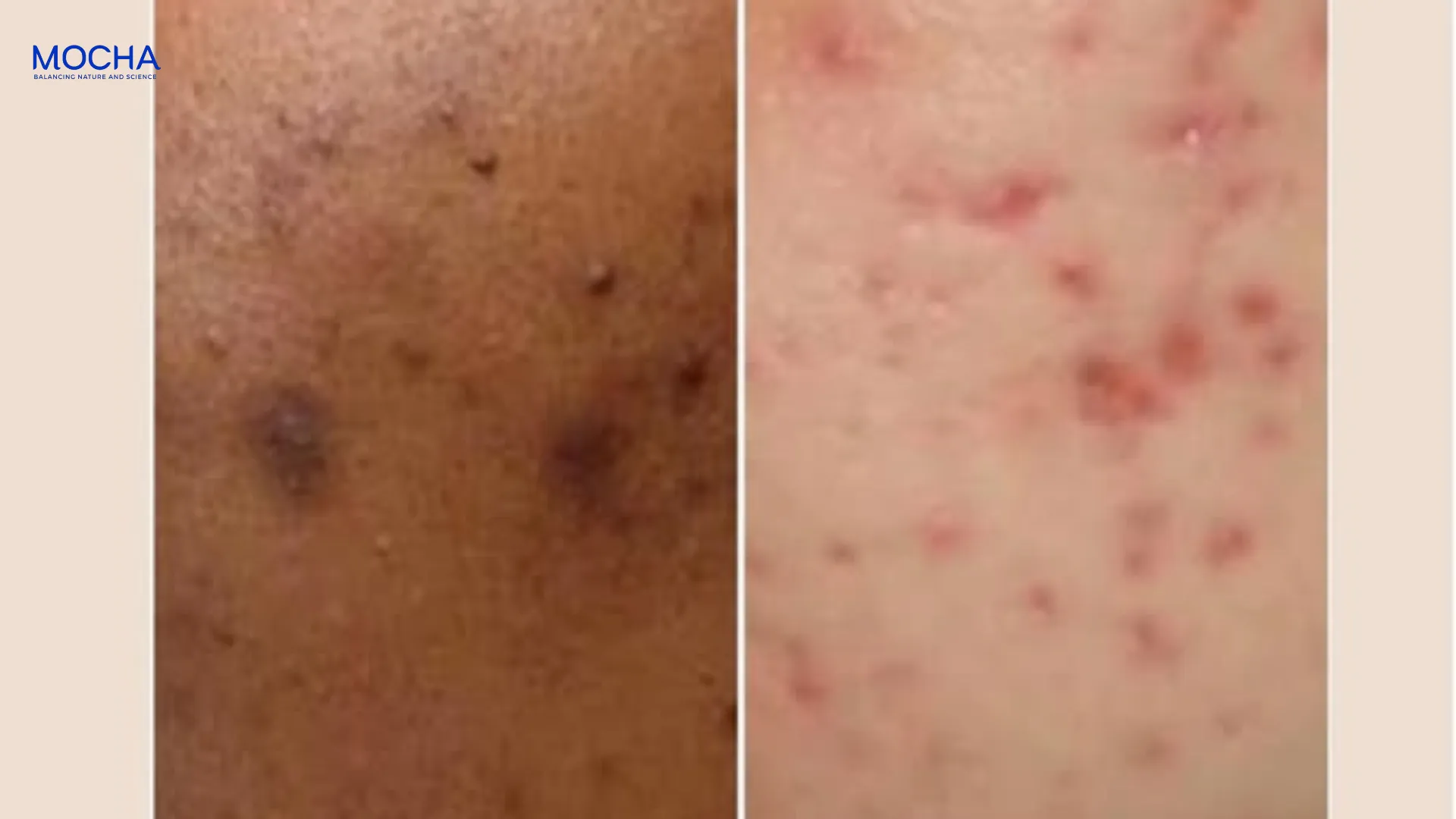 3 cơ chế từ kem giảm thâm mụn dầu mù u