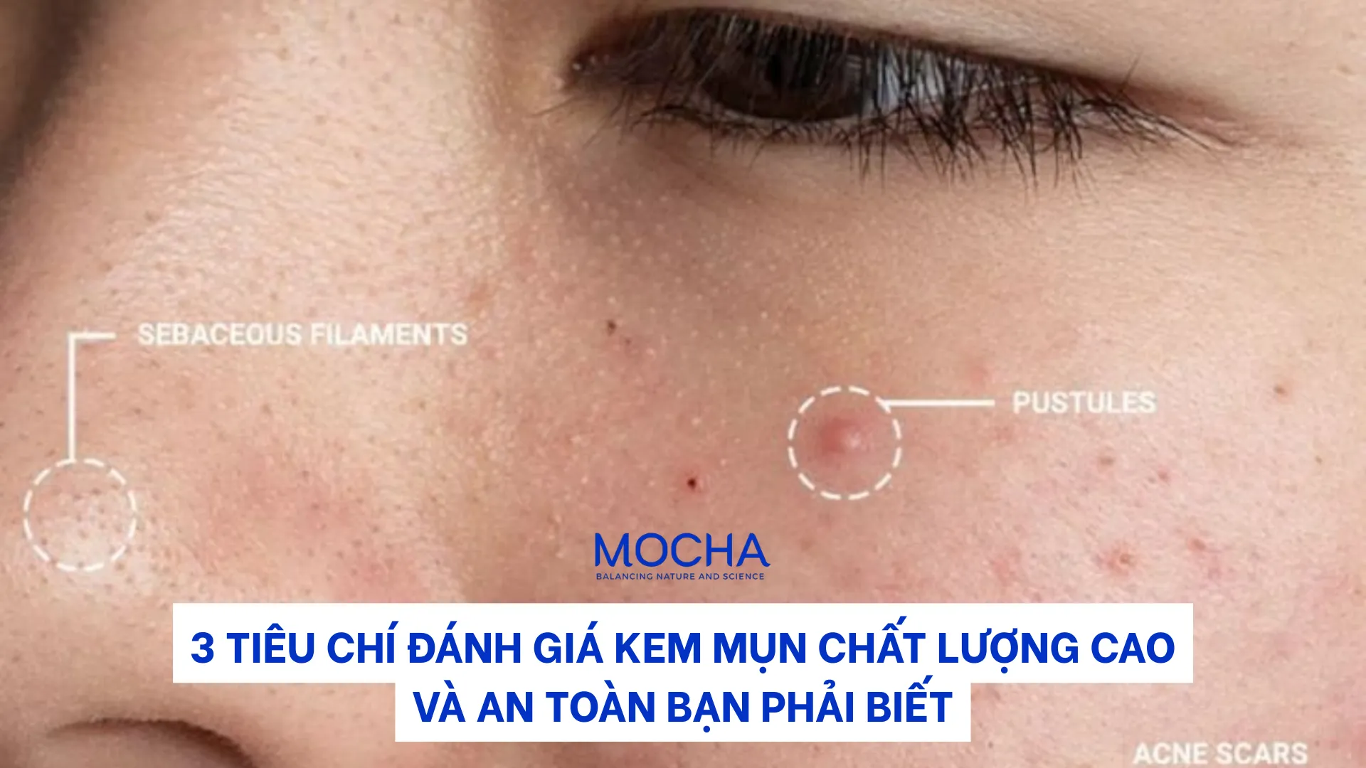 3 tiêu chí đánh giá kem mụn chất lượng cao và an toàn bạn phải biết