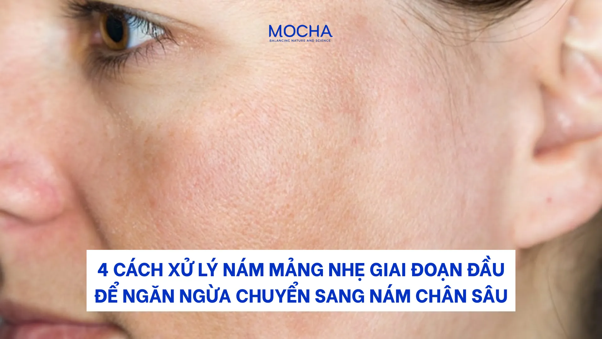 4 cách xử lý nám mảng nhẹ giai đoạn đầu để ngăn ngừa chuyển sang nám chân sâu