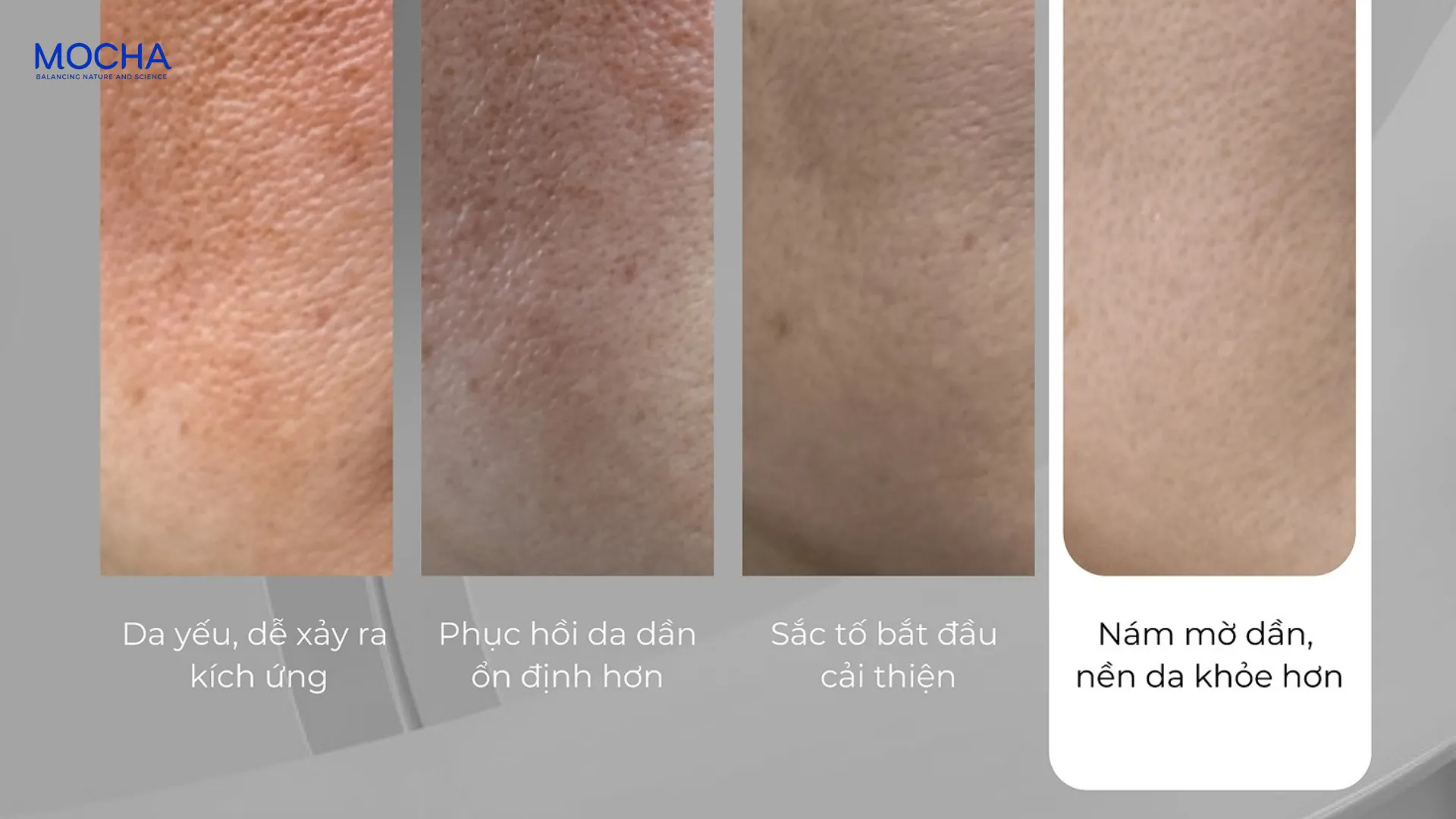 Nám mờ đi khi nào? 5 dấu hiệu tích cực khi dùng serum trị nám bạn cần biết